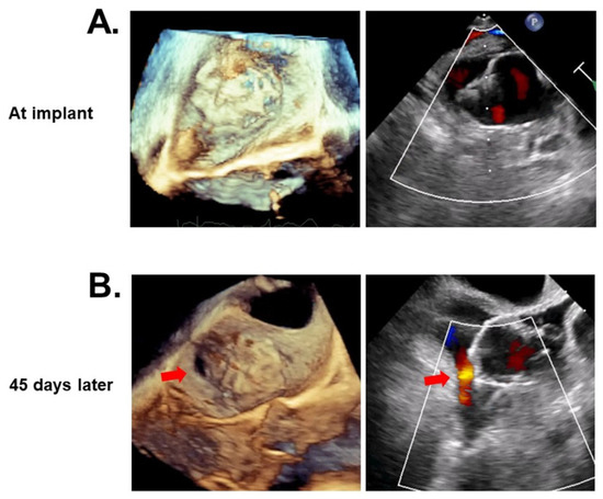Comparison in Short-Term Safety and Efficacy between New