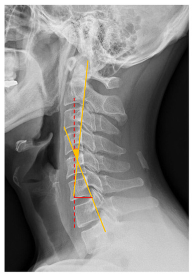 Association between Sagittal Cervical Spinal Alignment and Degenerative ...
