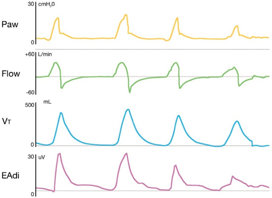 Ganar leyendo Escupir JCM | Free Full-Text | Neurally Adjusted Ventilatory Assist in Acute Respiratory Failure—A Narrative Review Ganar leyendo Escupir JCM | Free Full-Text | Neurally Adjusted Ventilatory Assist in Acute Respiratory Failure—A Narrative Review