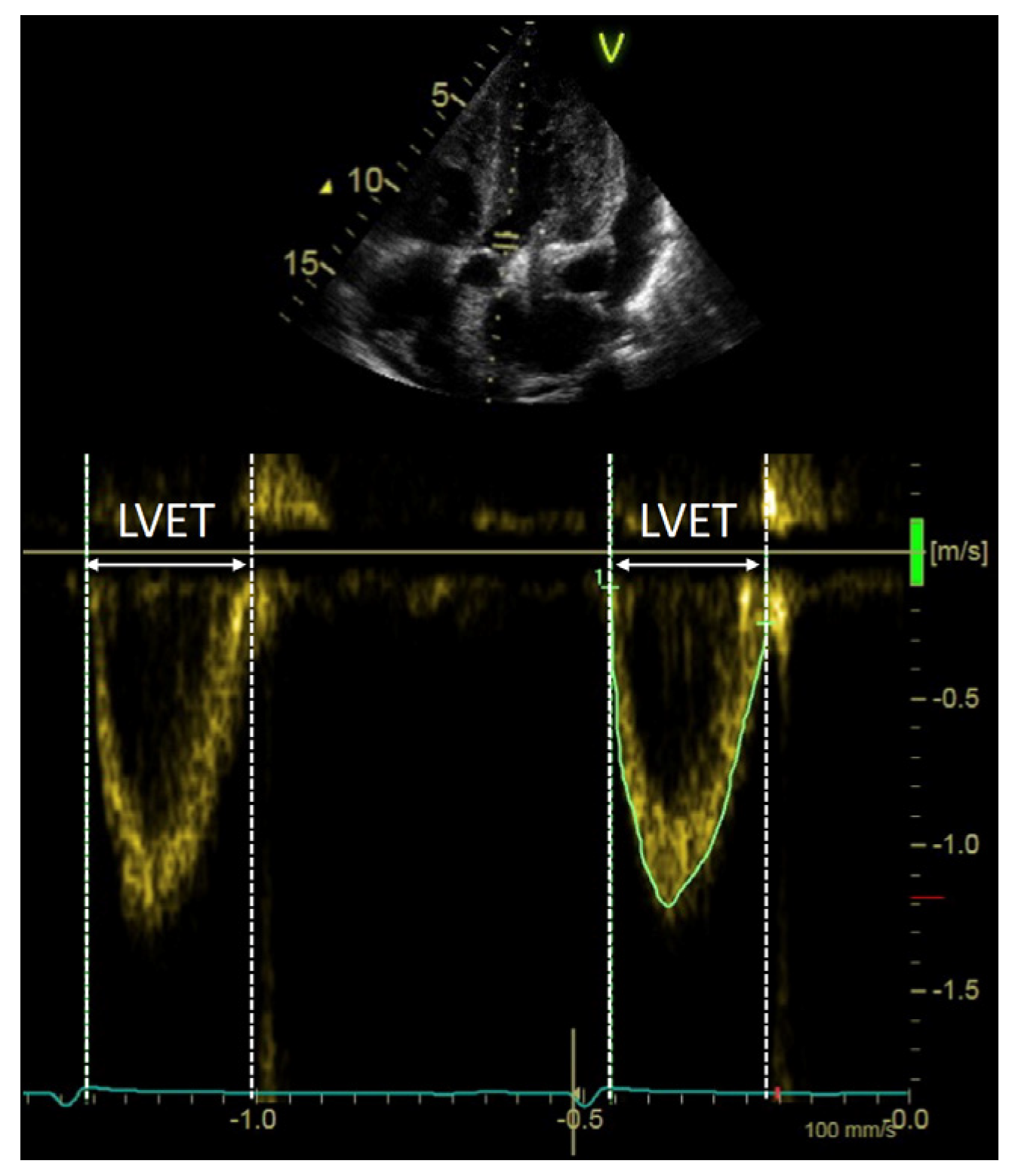 | Full-Text Value of Left Ventricular Indexed Ejection to Characterize the Severity of Aortic Stenosis