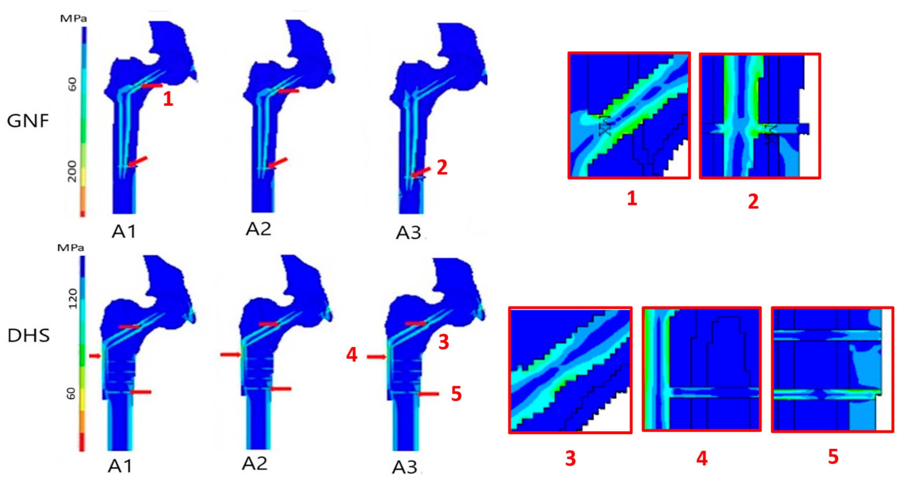 JCM | Free Full-Text | In Silico Finite Element Modeling of Stress  Distribution in Osteosynthesis after Pertrochanteric Fractures