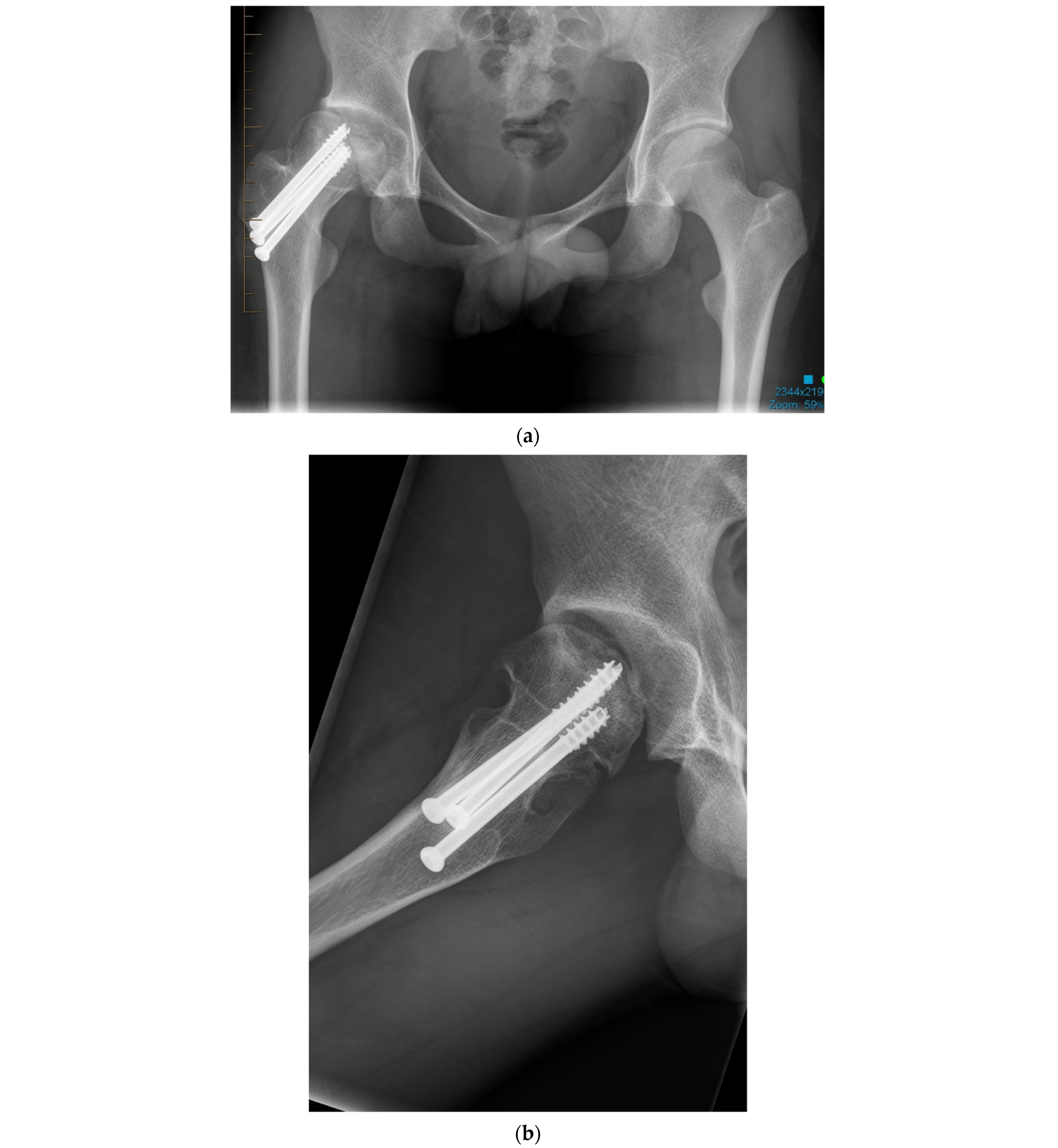 Personalized Hip Joint Replacement with Large Diameter Head