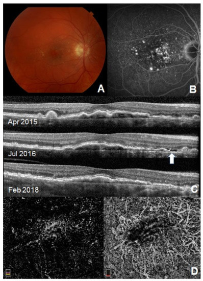 Cnv Macula Oct 5 Line Subthreshold Exudative Choroidal Neovascularization (CNV): Presentation ...