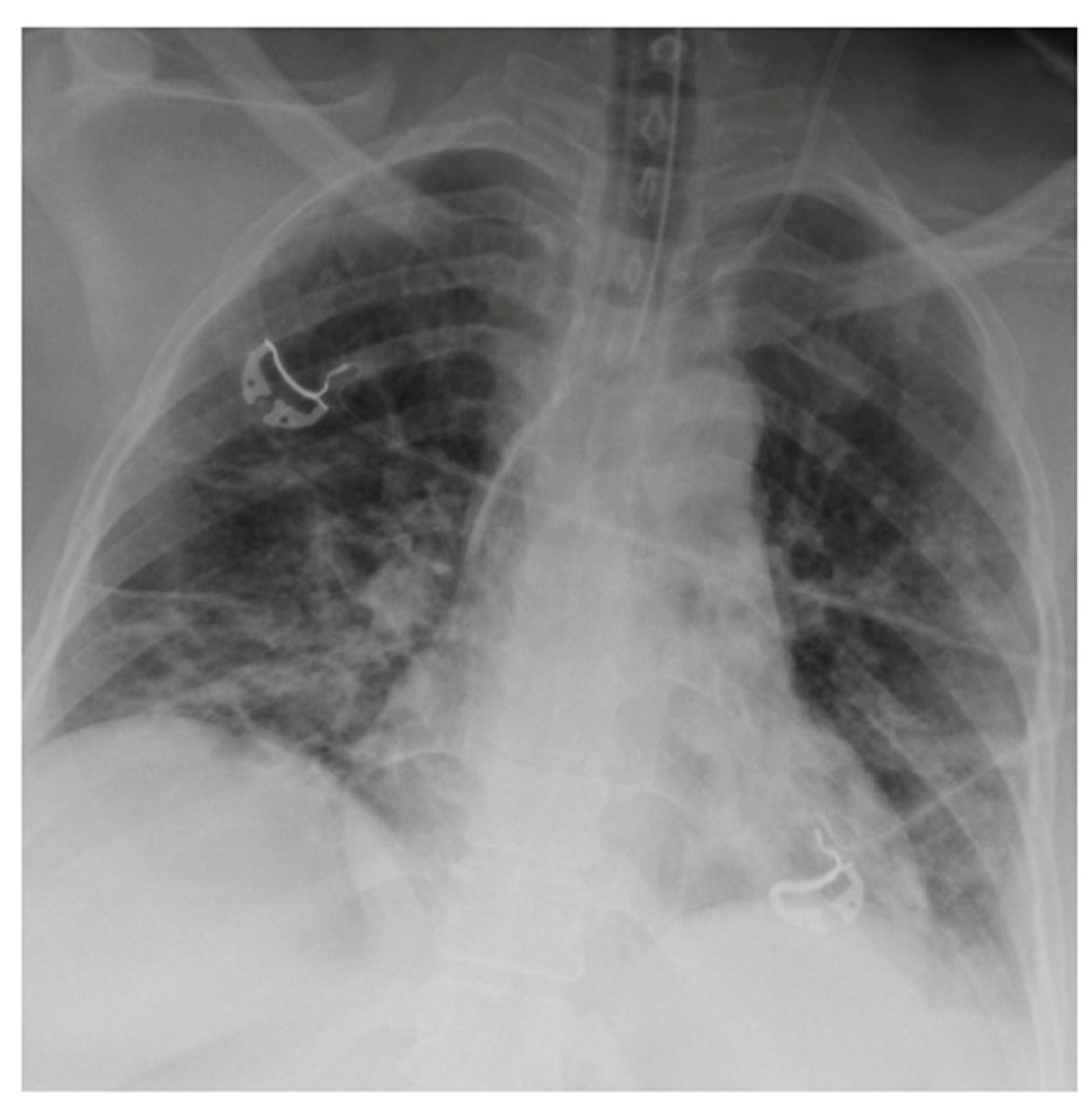 JCM Free FullText Role of a Chest Xray Severity Score in a