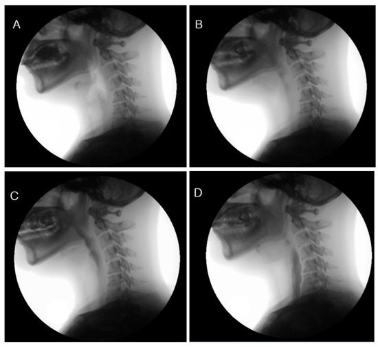 JCM Free FullText Efficacy of Laryngeal Rehabilitation Therapy on