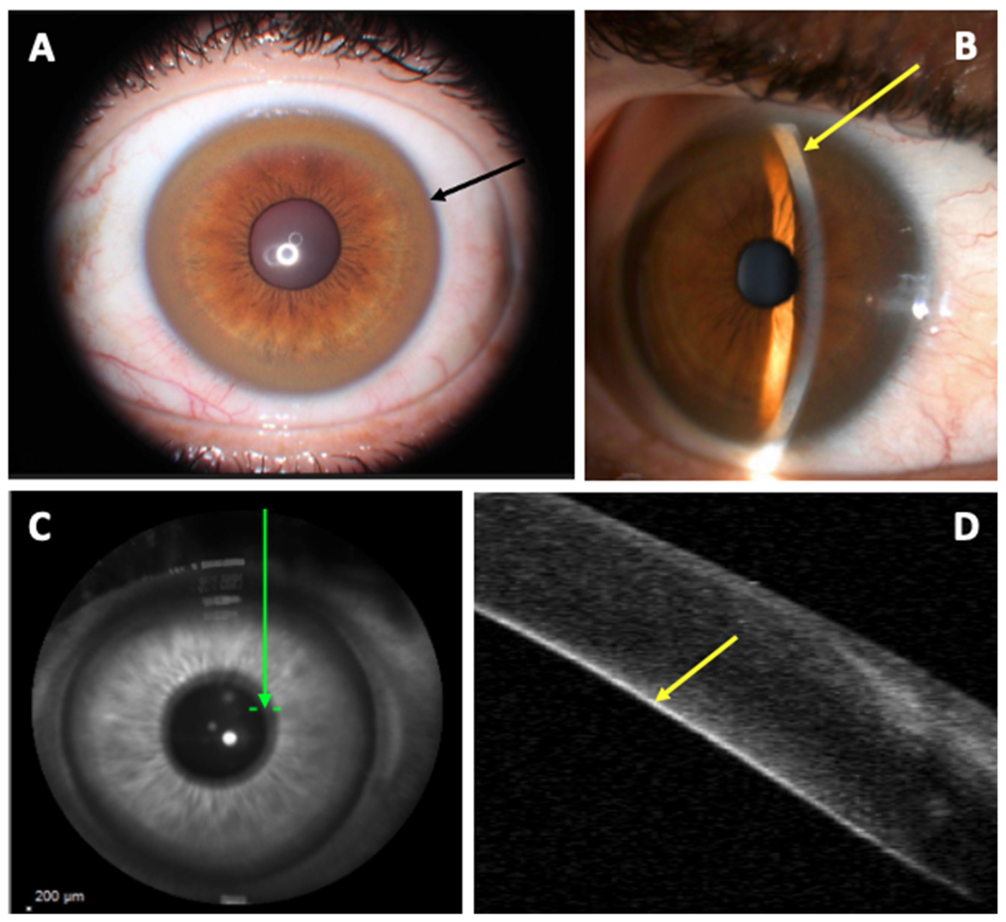 Kayser–Fleischer ring in two Siblings of Wilson's disease - YouTube