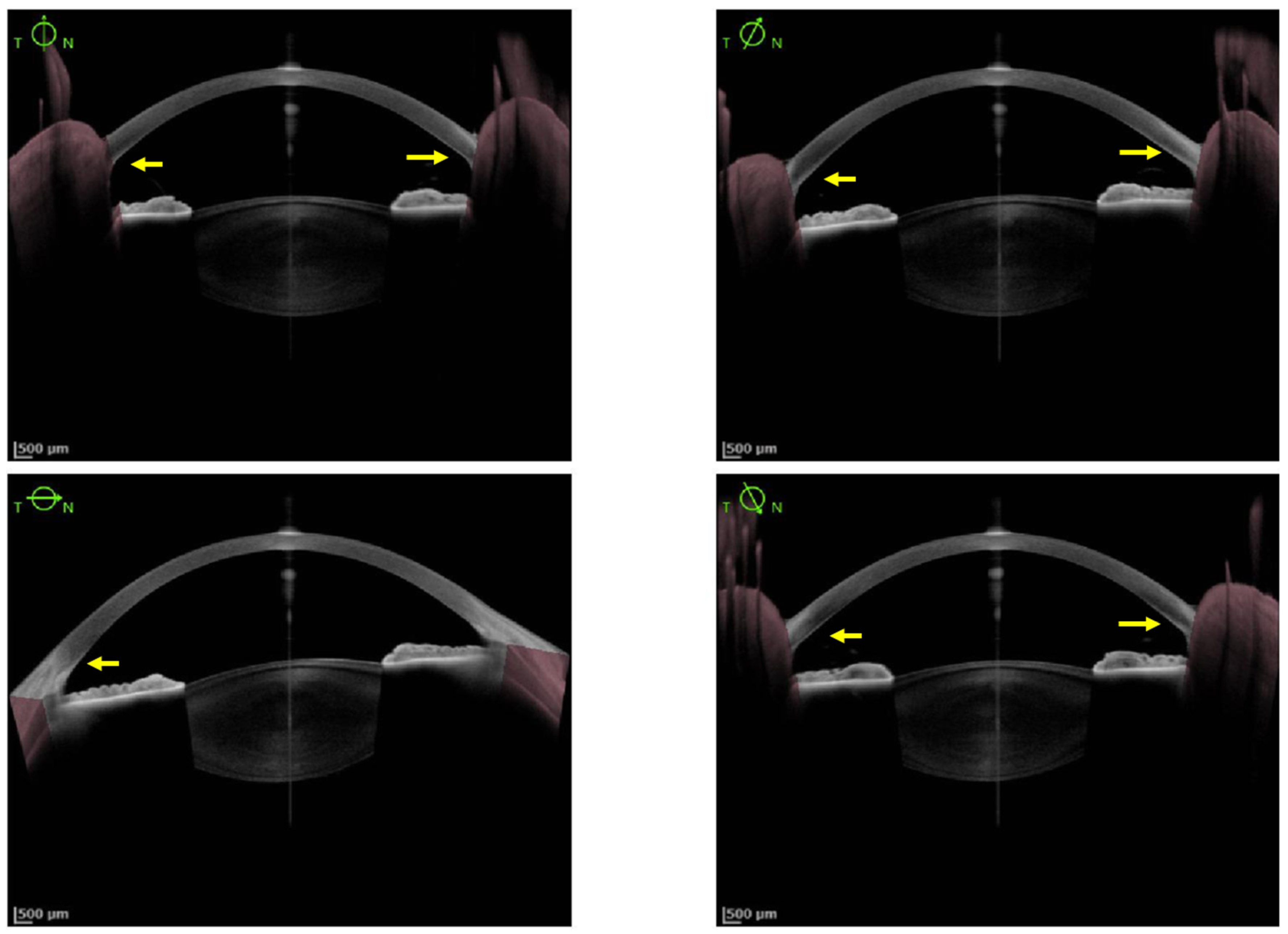 JCM | Free Full-Text | Eye Involvement in Wilson’s Disease: A Review  of the Literature