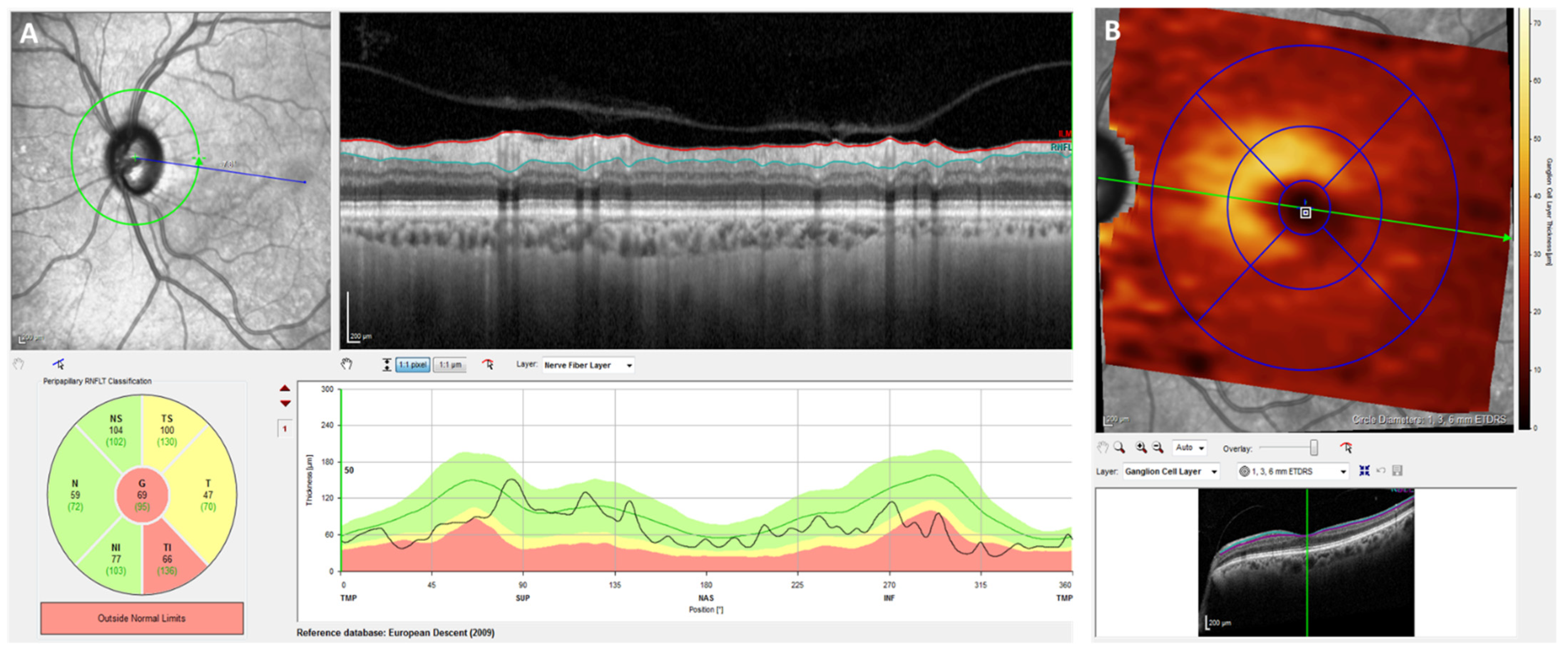 Eye Involvement in Wilson's Disease: A Review of the Literature