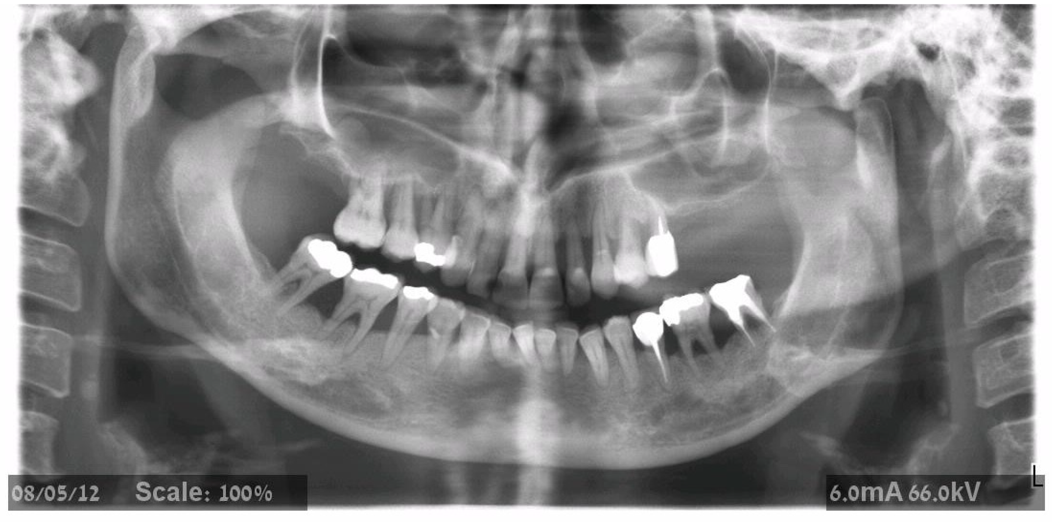 Maxillary Tuberosity Radiograph