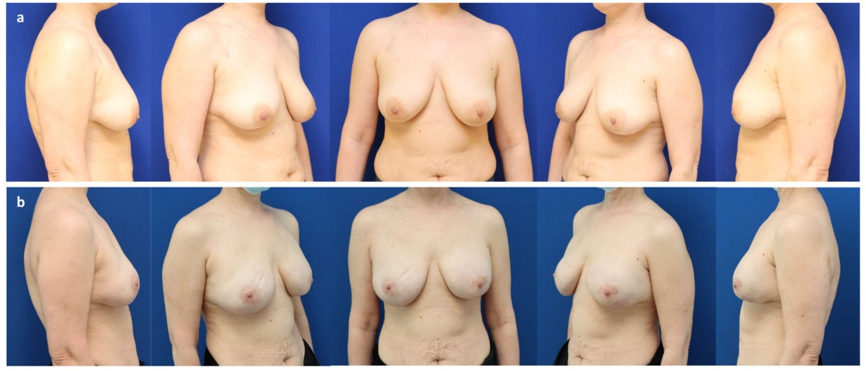 Can You Make Your Reconstructed Breasts Smaller During Stage 2? - PRMA