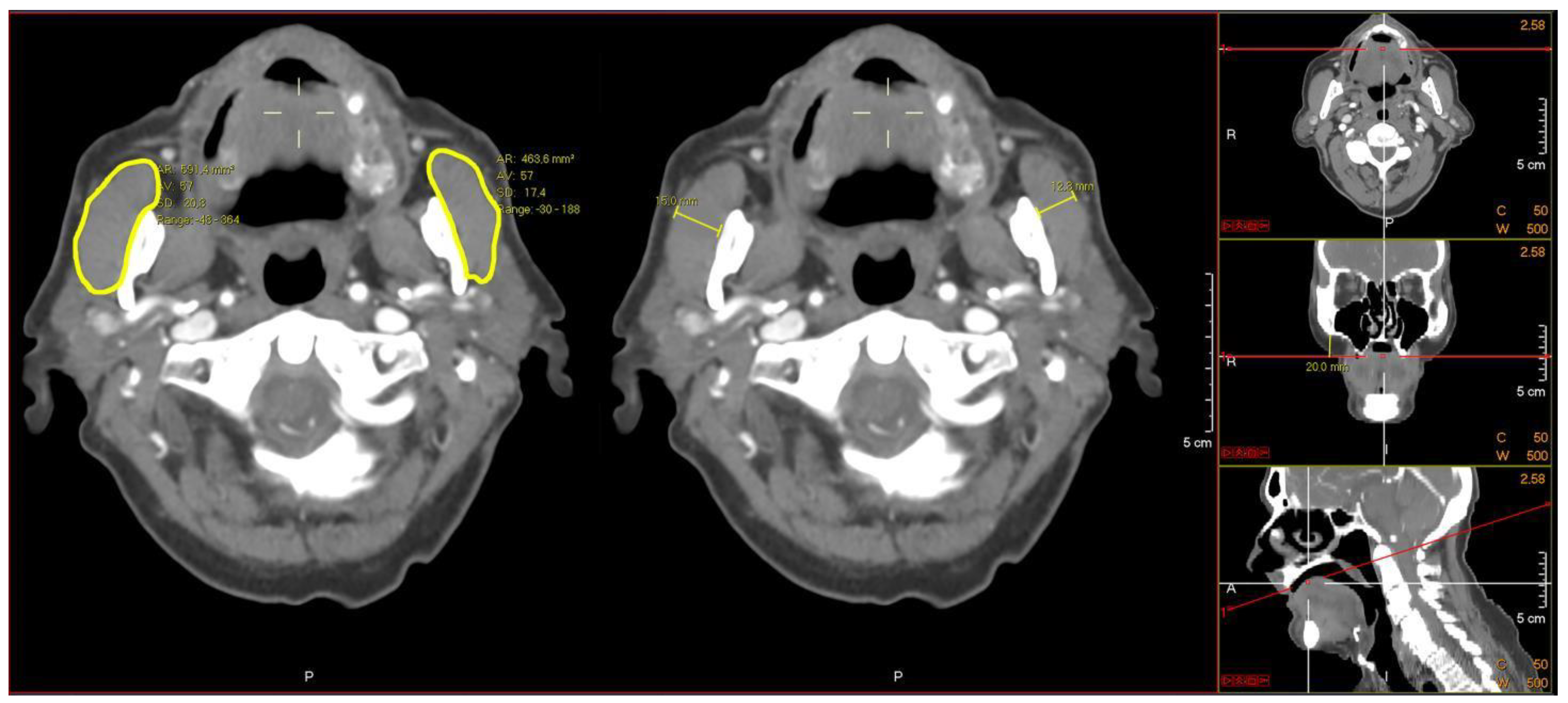 Association between Masseter Muscle Area and Thickness and