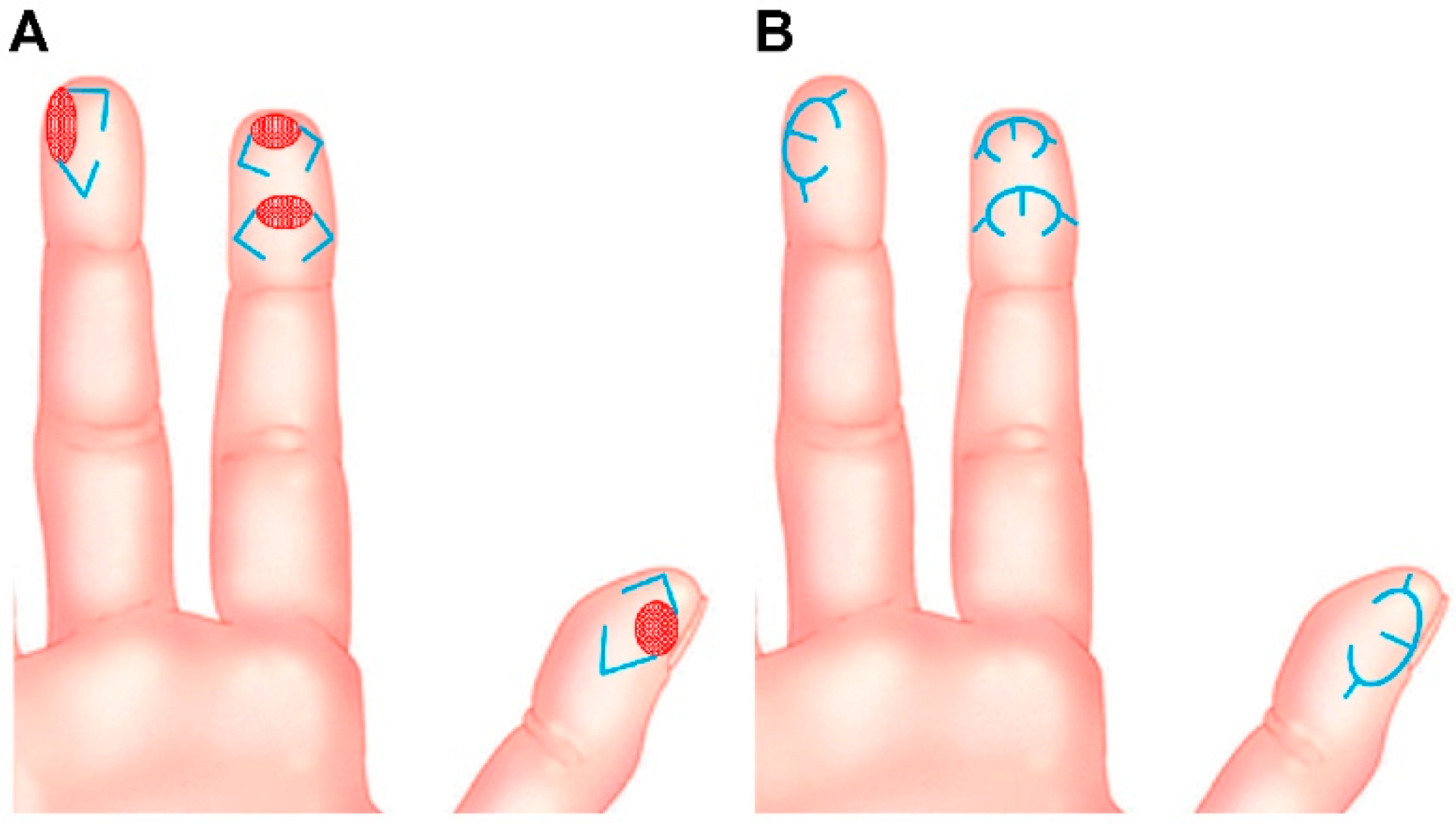 JCM Free FullText Modified MiniKeystone Flaps for Coverage of