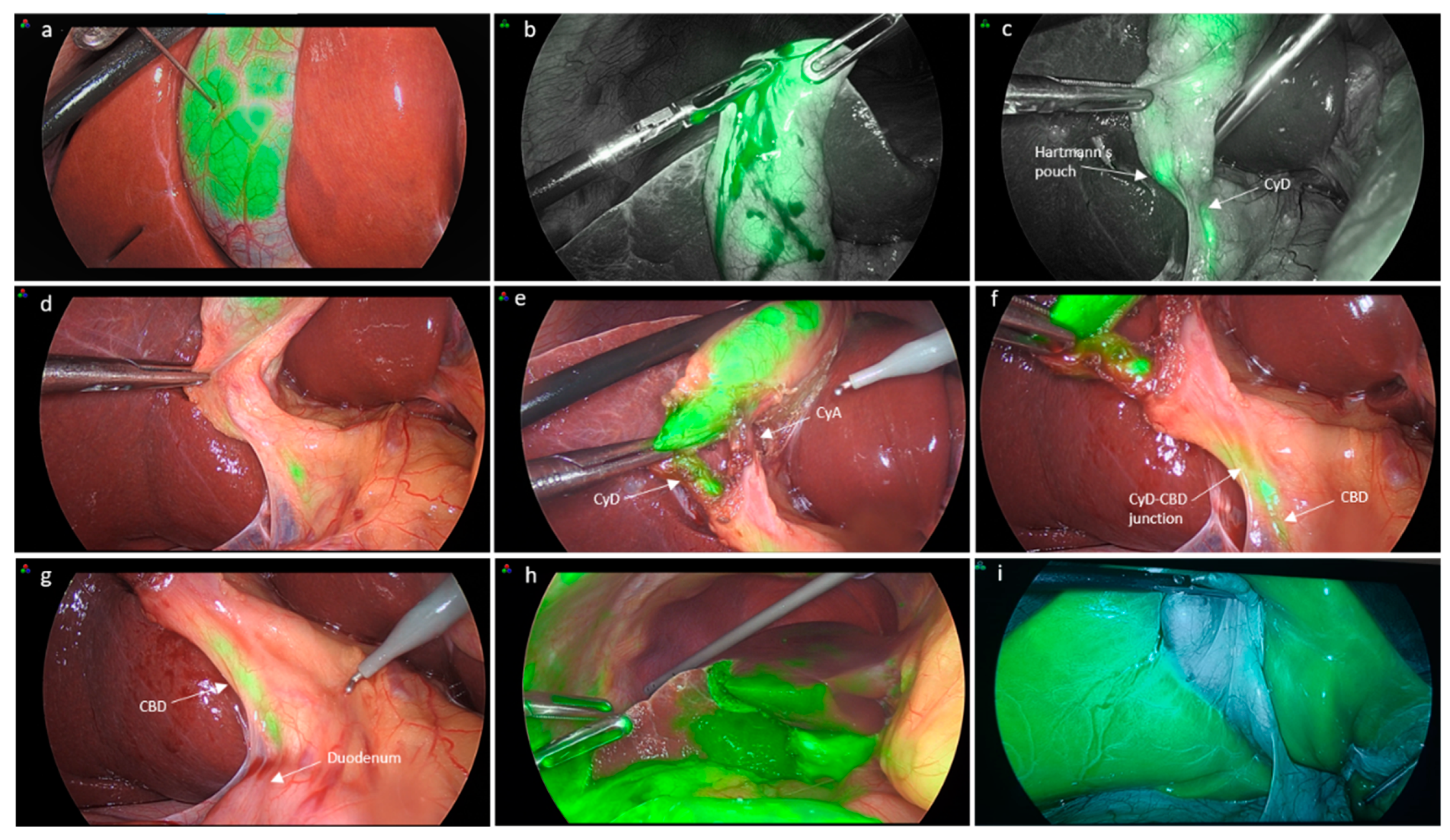 JCM | Free Full-Text | Intracholecystic versus Intravenous Indocyanine ...