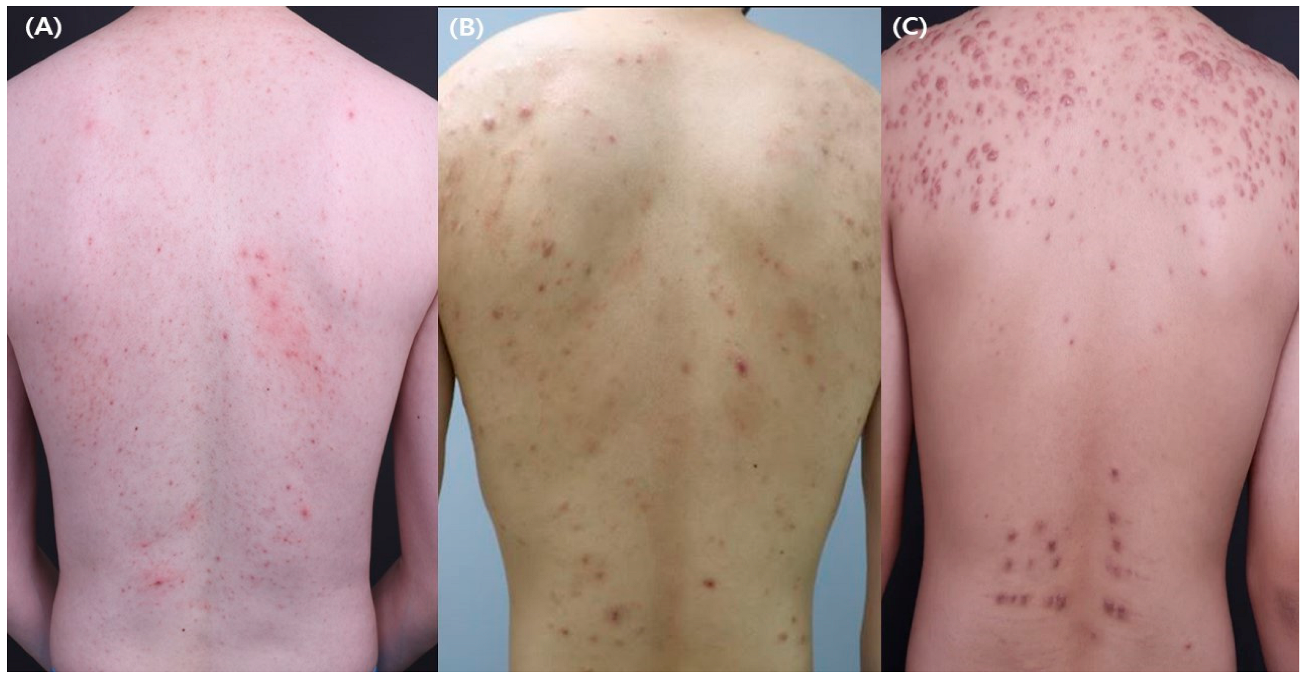 JCM | Free Full-Text | Truncal Acne: An Overview