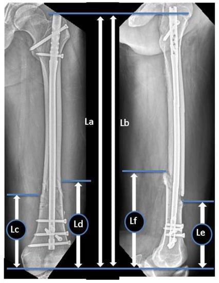 Optimal entry point for antegrade and retrograde femoral intramedullary  nails | Chinese Journal of Traumatology