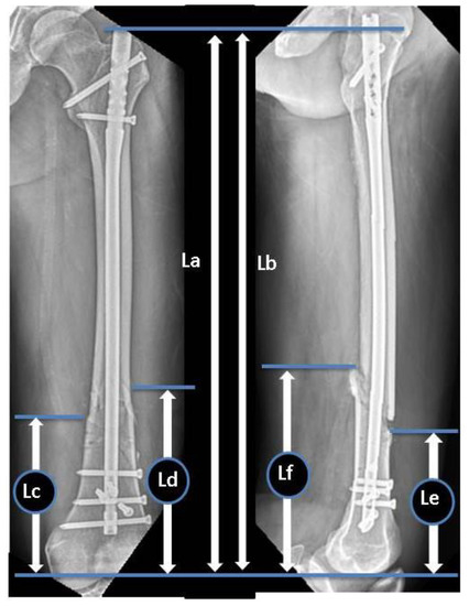 Distal Tibial Fractures: Technique of IM Nailing : Wheeless' Textbook of  Orthopaedics