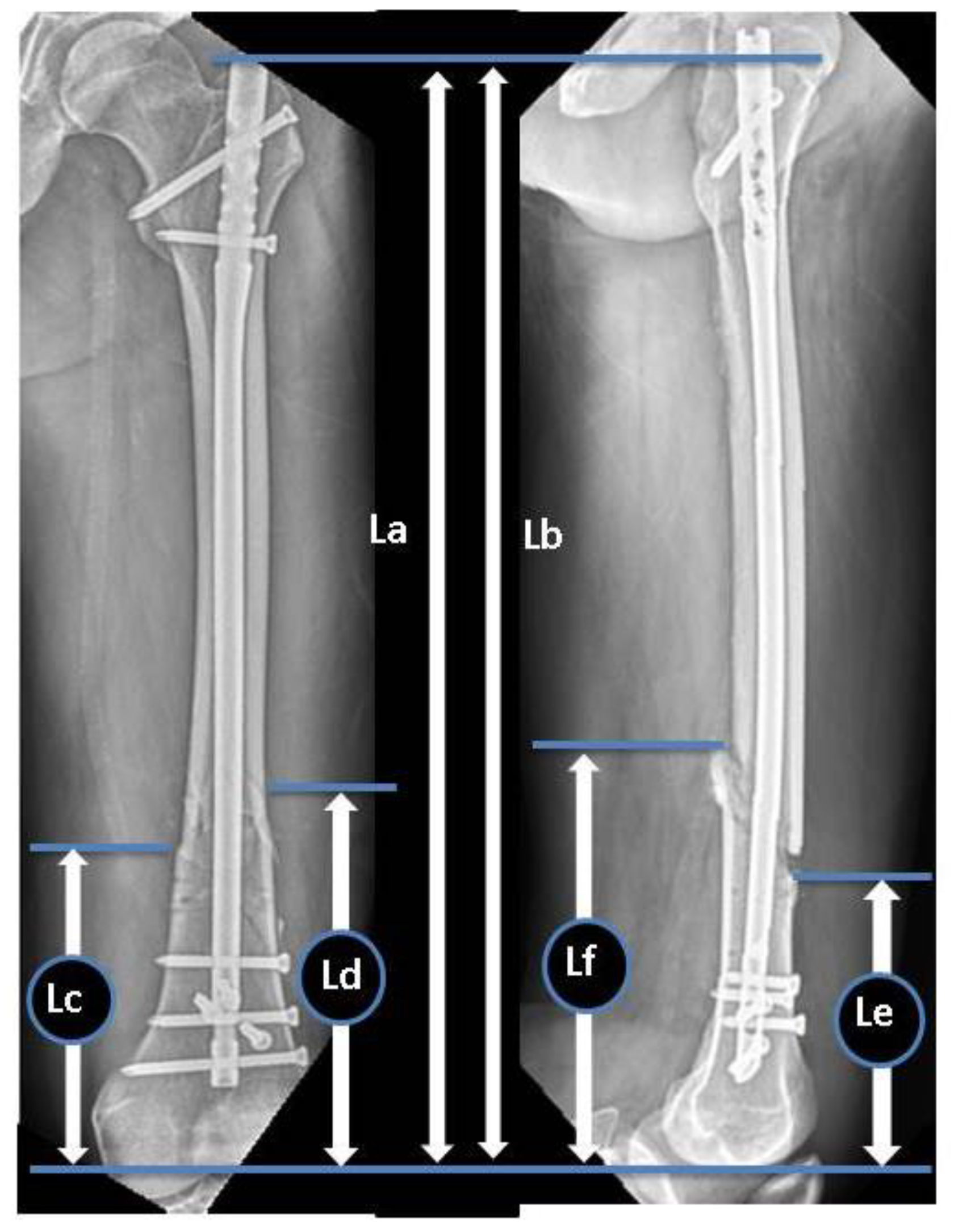 Frontiers | Determination of intramedullary nail based on centerline  adaptive registration