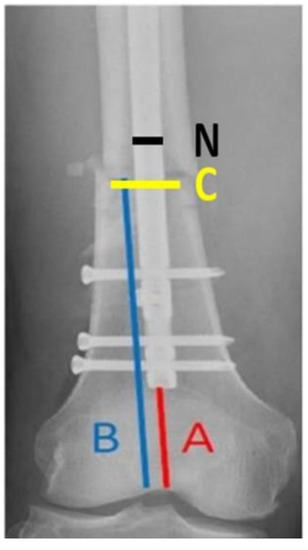 Plate augmentation combined with bone grafting for aseptic non-union of  femoral shaft fractures following interlocking nails
