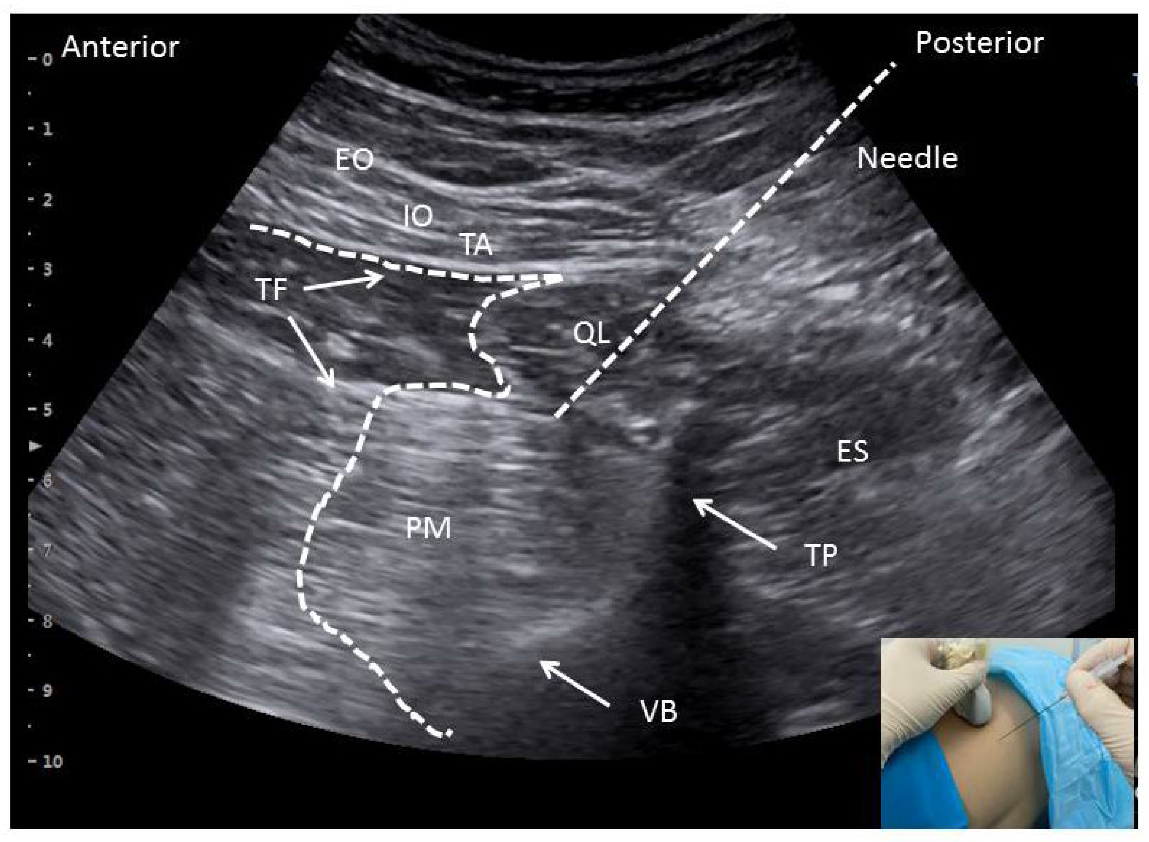 Quadratus Lumborum Muscle Mri