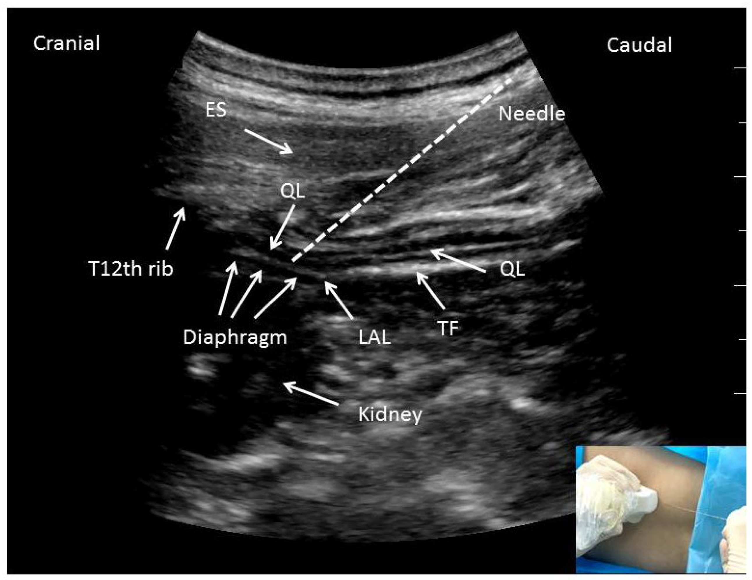 JCM Free FullText Anterior Quadratus Lumborum Block at the Lateral
