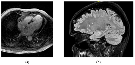 The Emerging Role of Combined Brain/Heart Magnetic Resonance