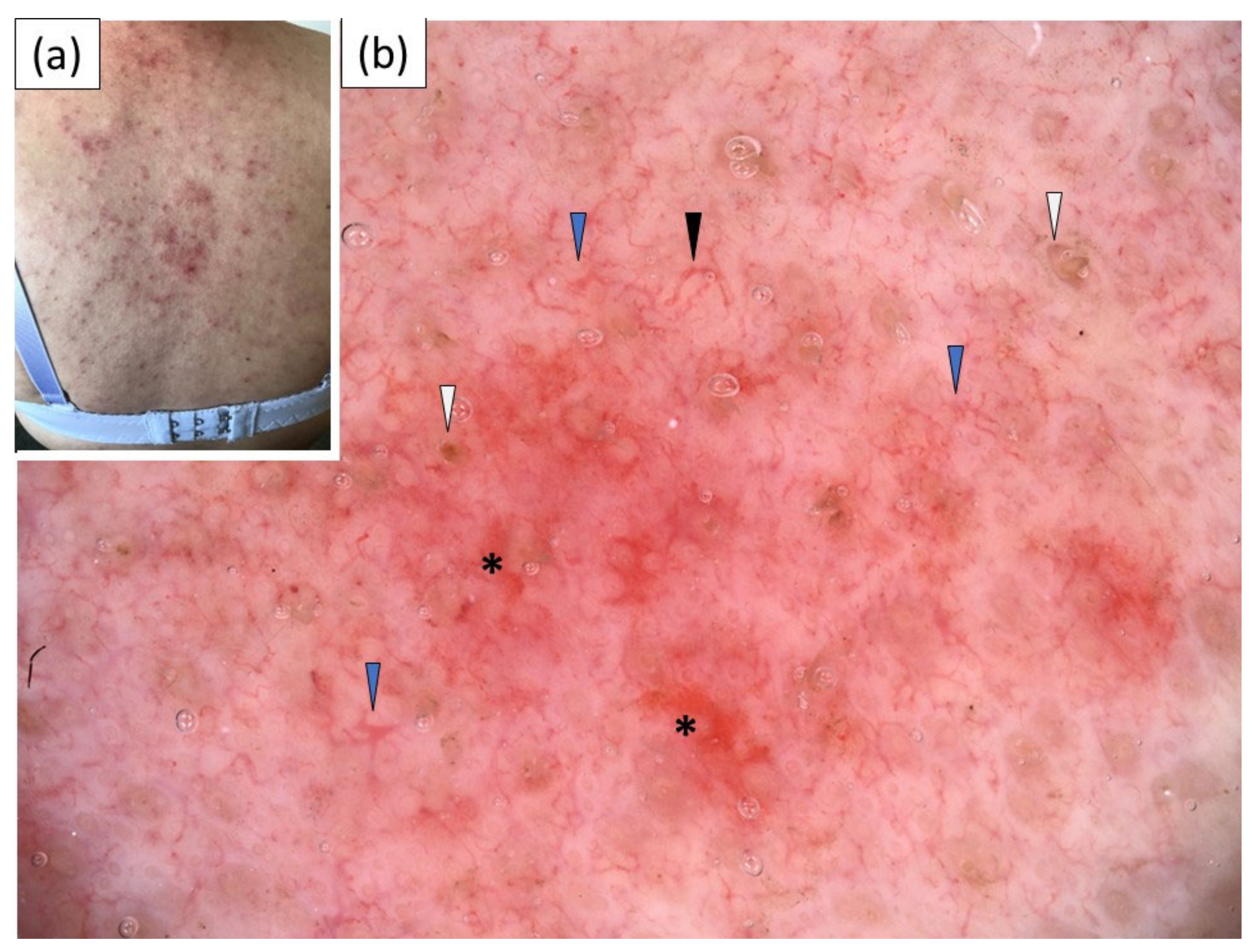 Jcm Free Full Text Dermoscopic Features Of Acute Subacute Chronic And Intermittent Subtypes Cutaneous Lupus Erythematosus In Caucasians