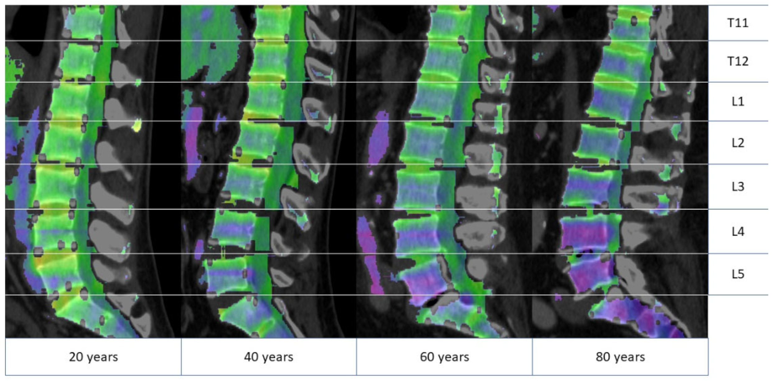 Dual-Energy Computed Tomography-Based Quantitative Bone
