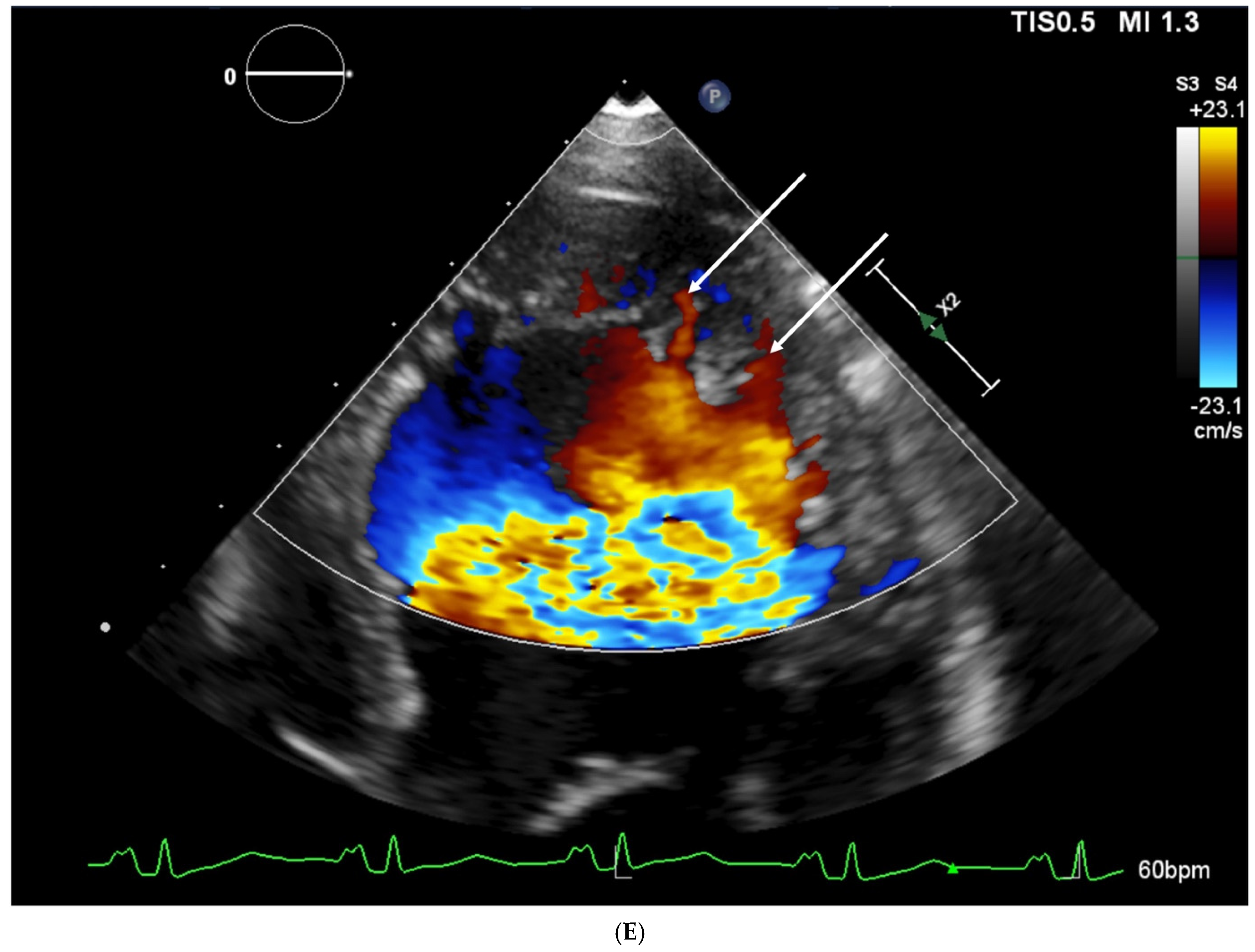 Southwest Journal of Pulmonary, Critical Care and Sleep - Imaging - Medical  Image of the Week: Left Ventricular Non-compaction