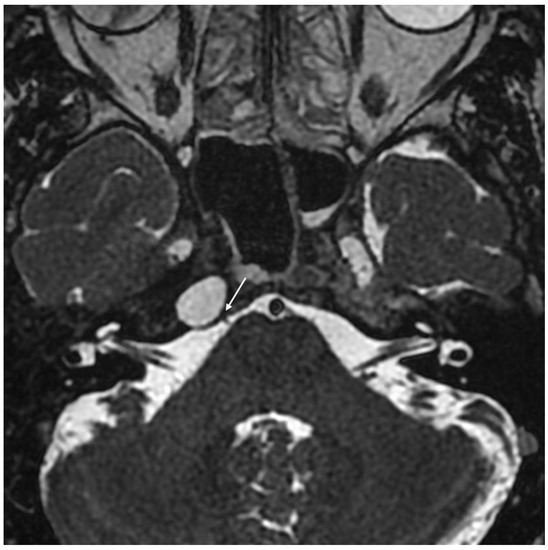 JCM Free FullText Typical and Atypical Symptoms of Petrous Apex
