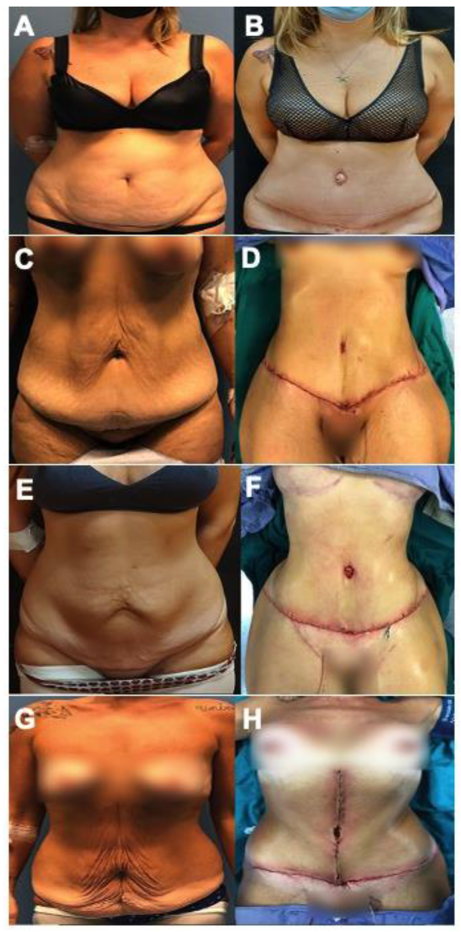 Best Liposuction Back Before After @ Medini