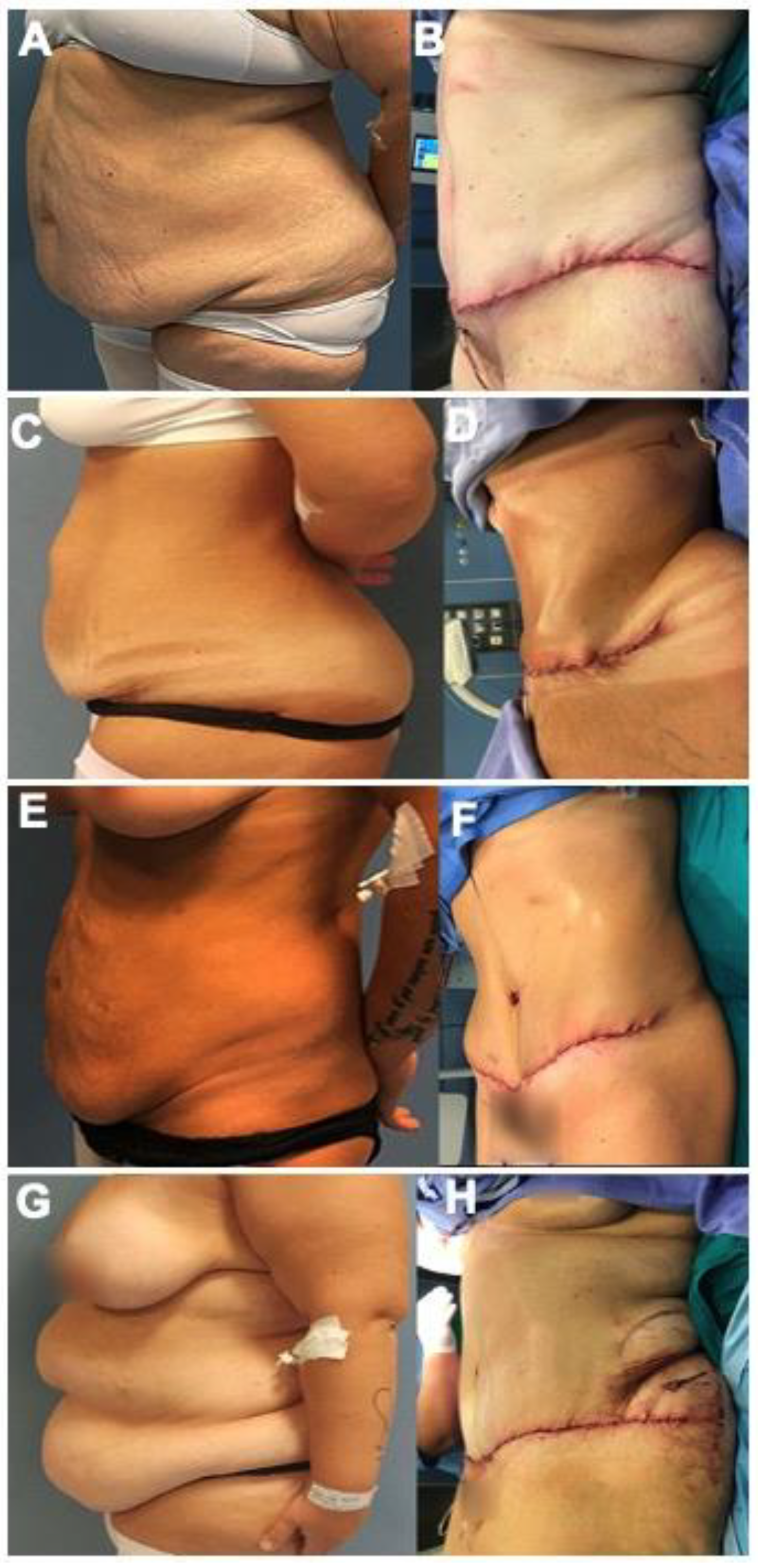 Abdominoplasty - Laser and Classic - Body Surgery - Dr Ciric