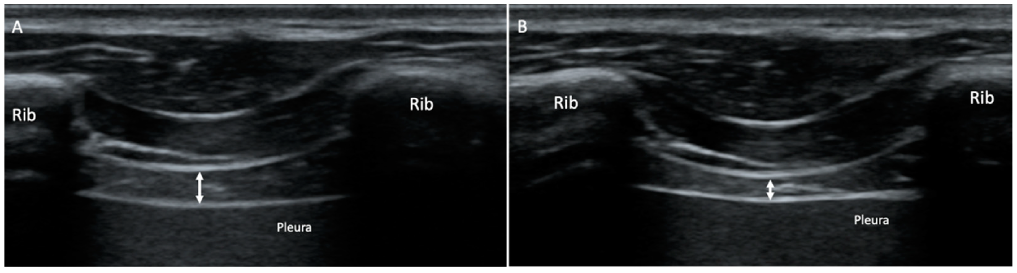 JCM Free Full-Text Effectiveness of Ultrasonography Visual Biofeedback of the Diaphragm in Conjunction with Inspiratory Muscle Training on Muscle Thickness, Respiratory Pressures, Pain, Disability, Quality of Life and Pulmonary Function