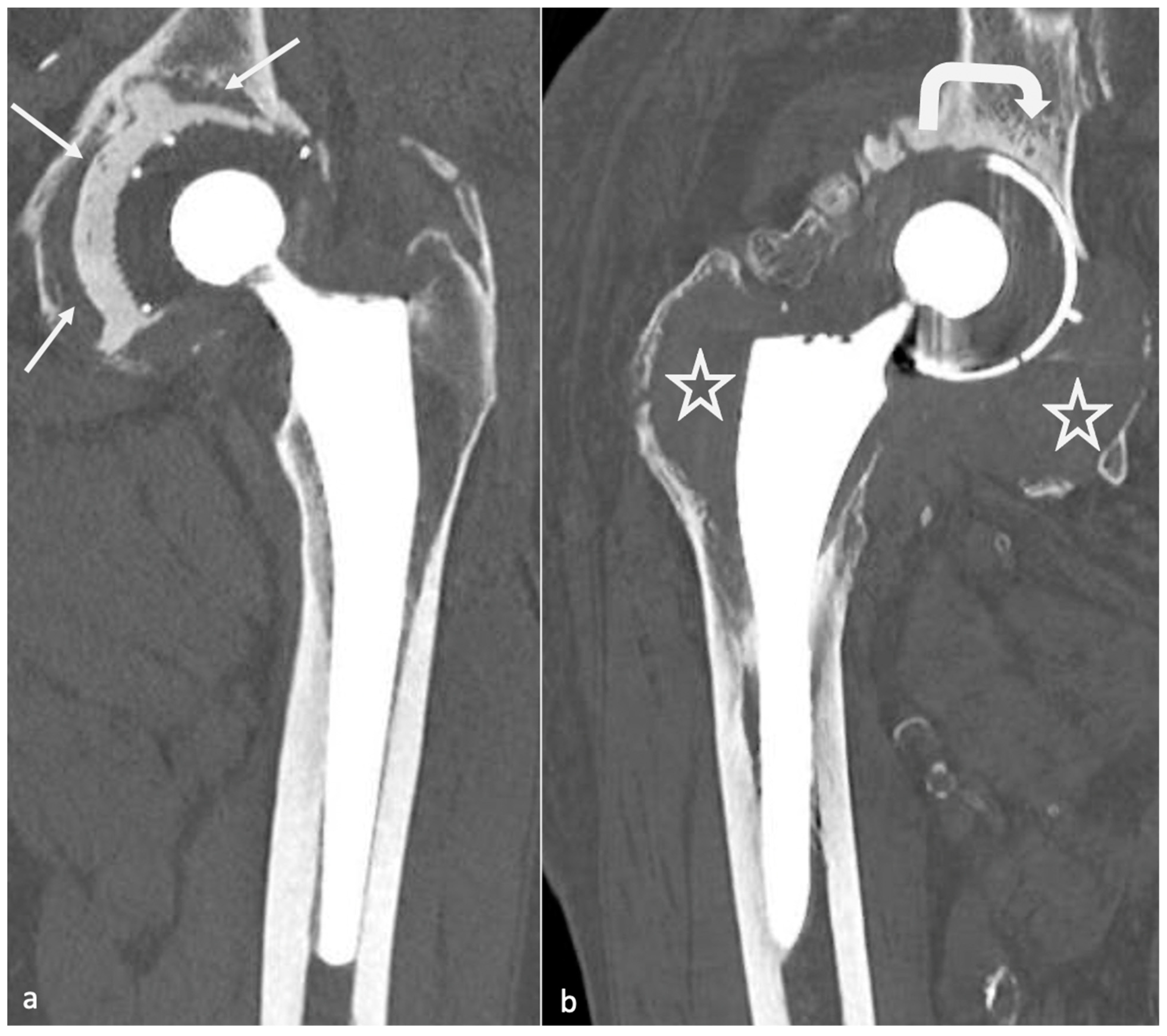Imaging in Hip Arthroplasty Management Part 2 Postoperative Diagnostic