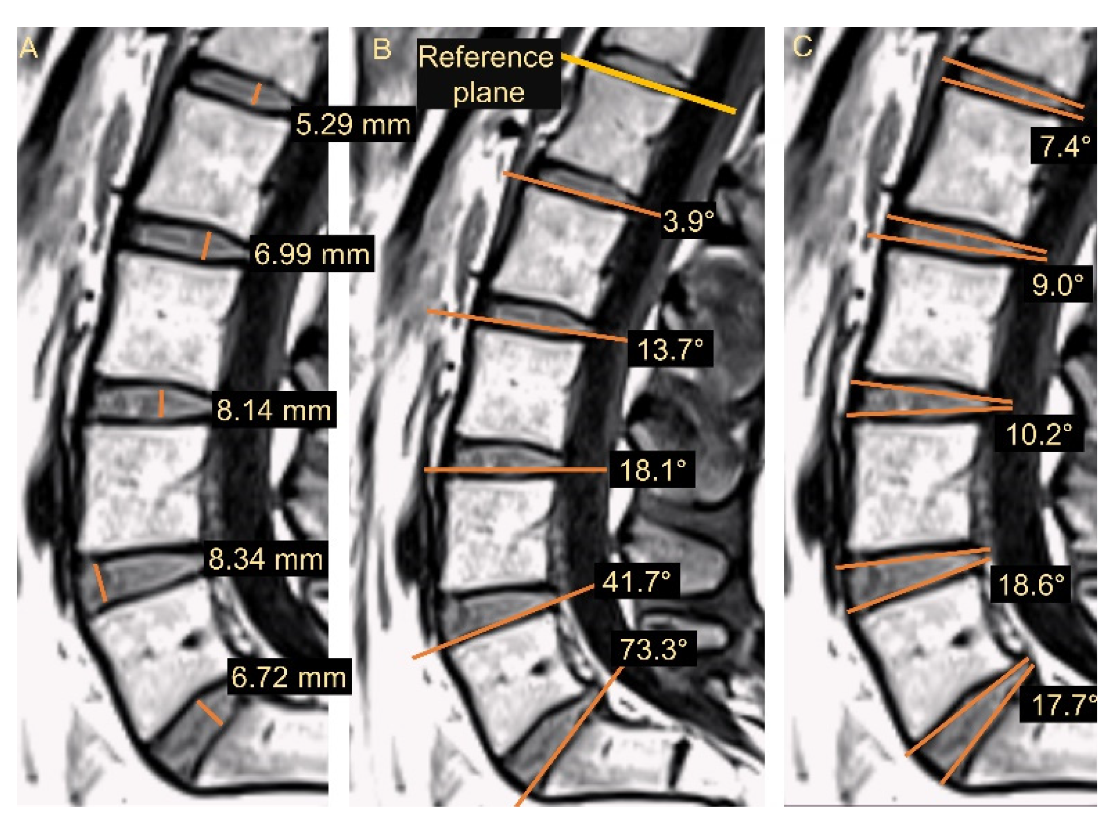 JCM Free FullText NonInvasive Evaluation of Intradiscal Deformation during Axial Loading