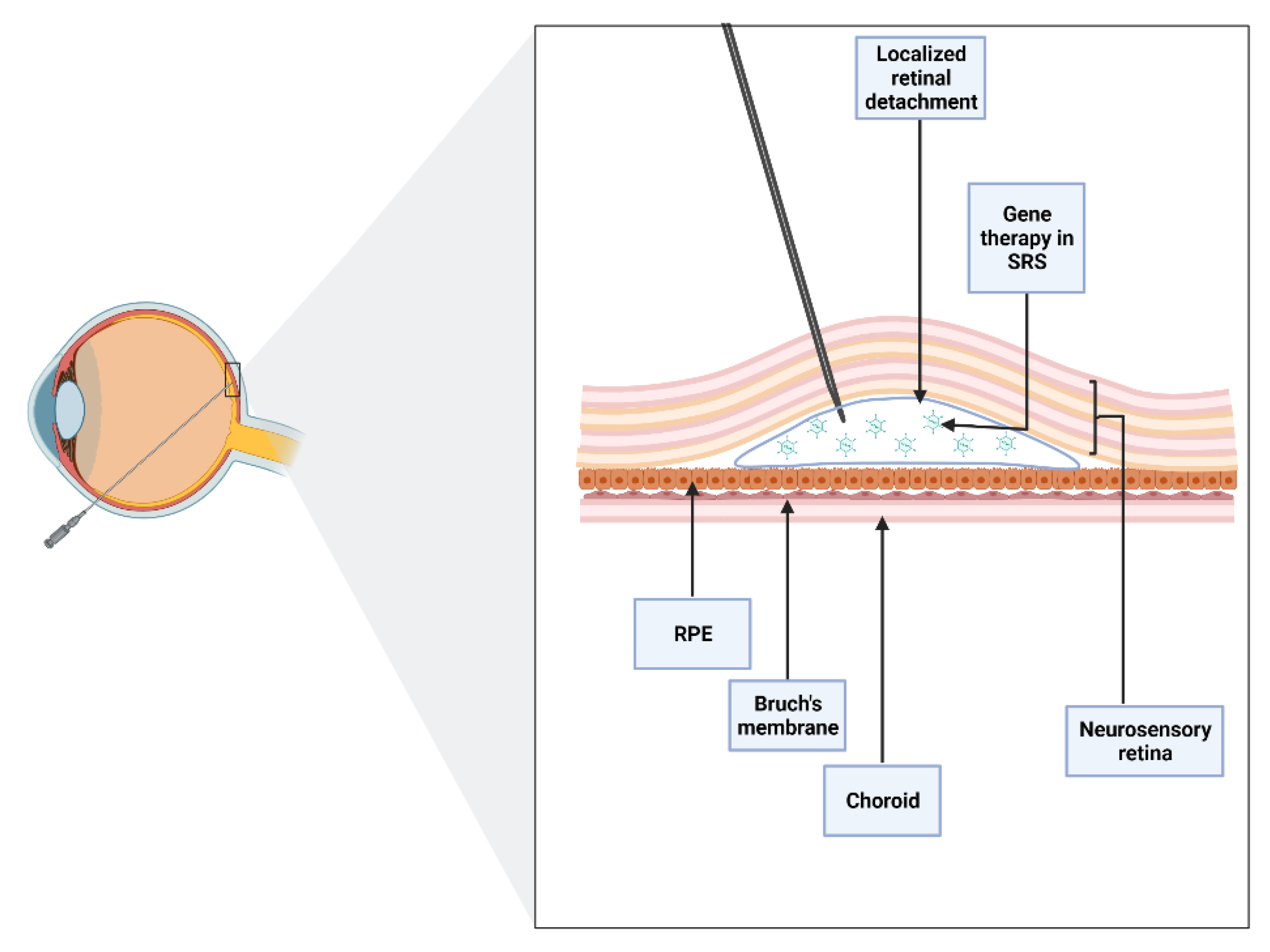 JCM Free FullText Subretinal Injection Techniques for Retinal