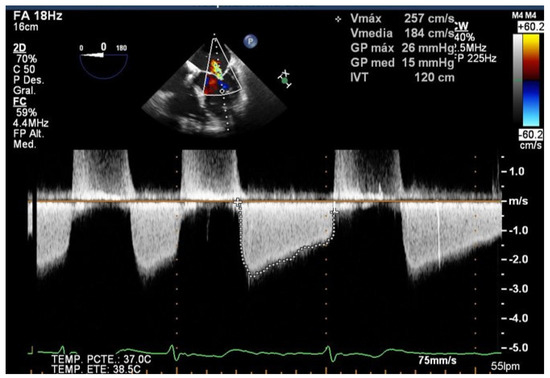 JCM | Free Full-Text | Complications of the Percutaneous Mitral Valve ...