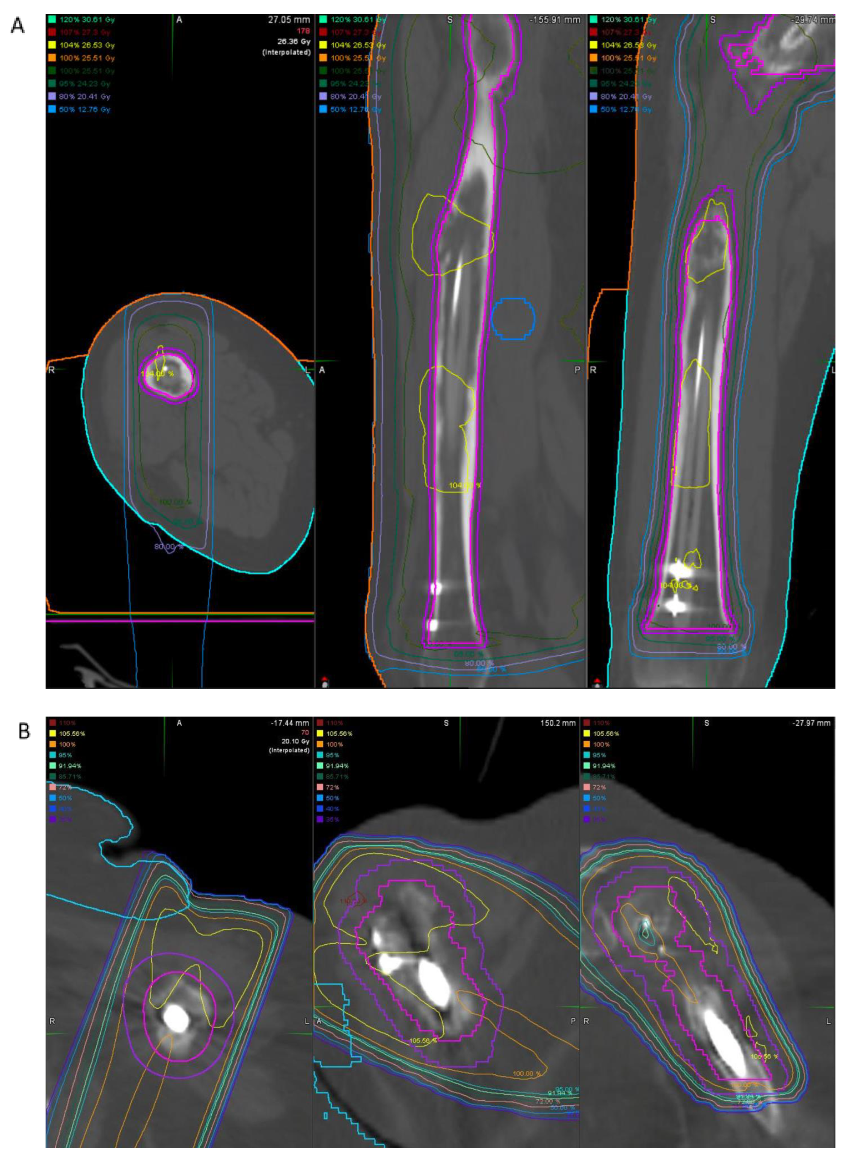 JCM | Free Full-Text | Carbon Fiber Implants in Orthopaedic Oncology JCM | Free Full-Text | Carbon Fiber Implants in Orthopaedic Oncology