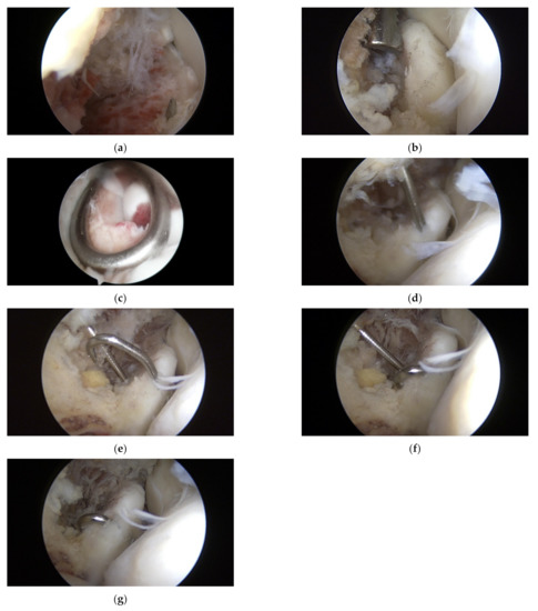 Arthroscopic Reduction and Fixation of Coronoid Fractures