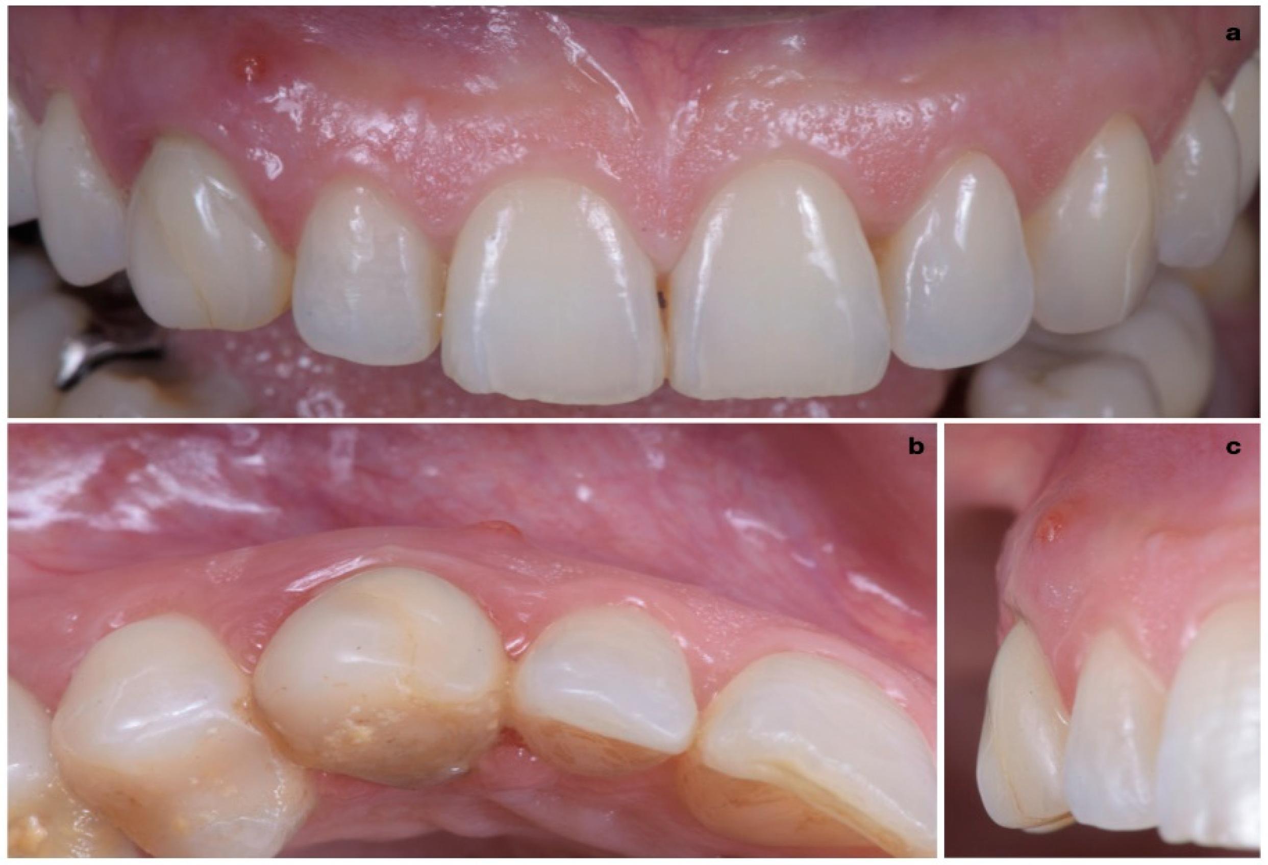 JCM Free FullText A Novel MucoGingival Approach for Immediate