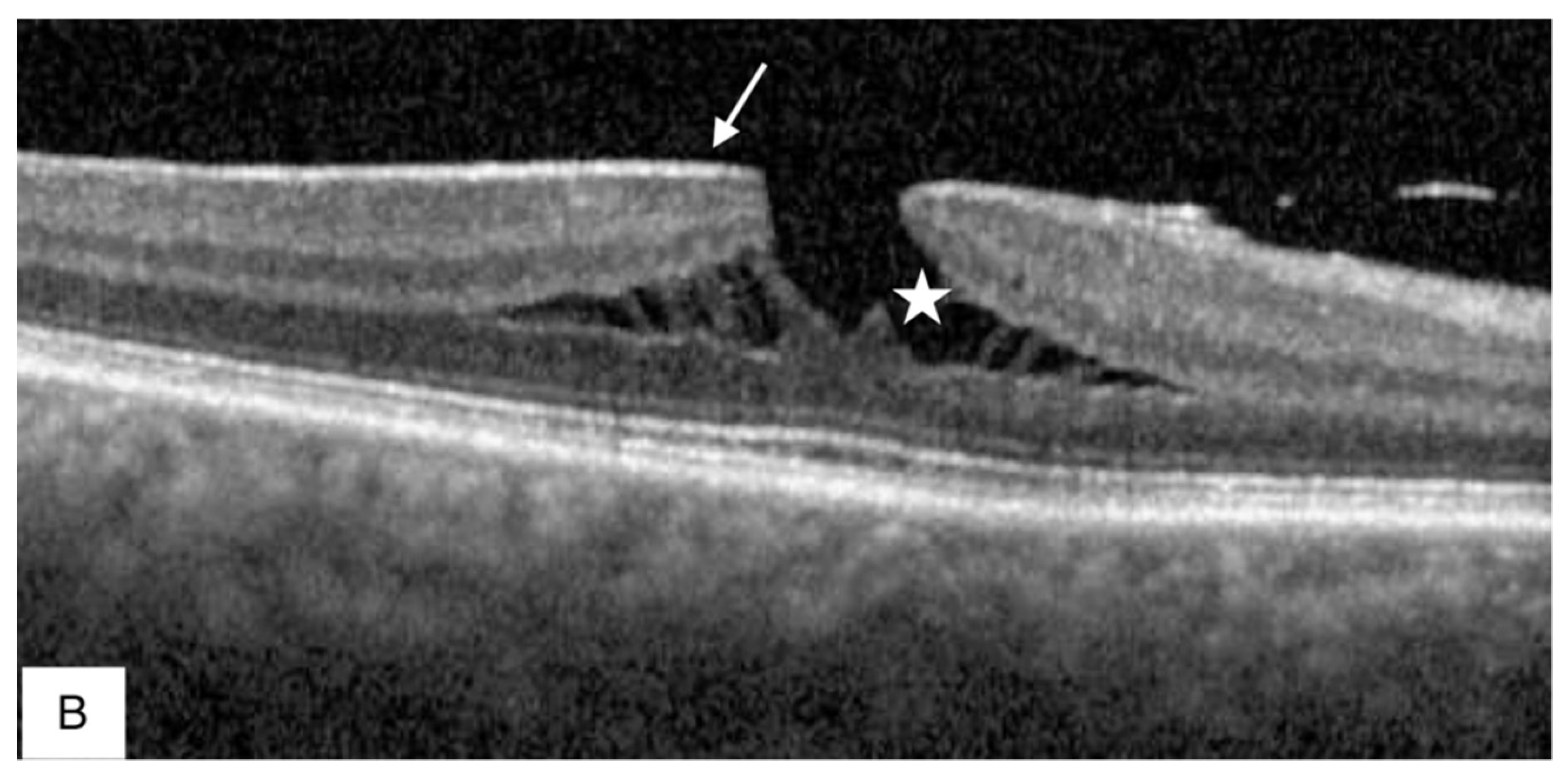 JCM | Free Full-Text | Primary Lamellar Macular Holes: To Vit or Not to Vit