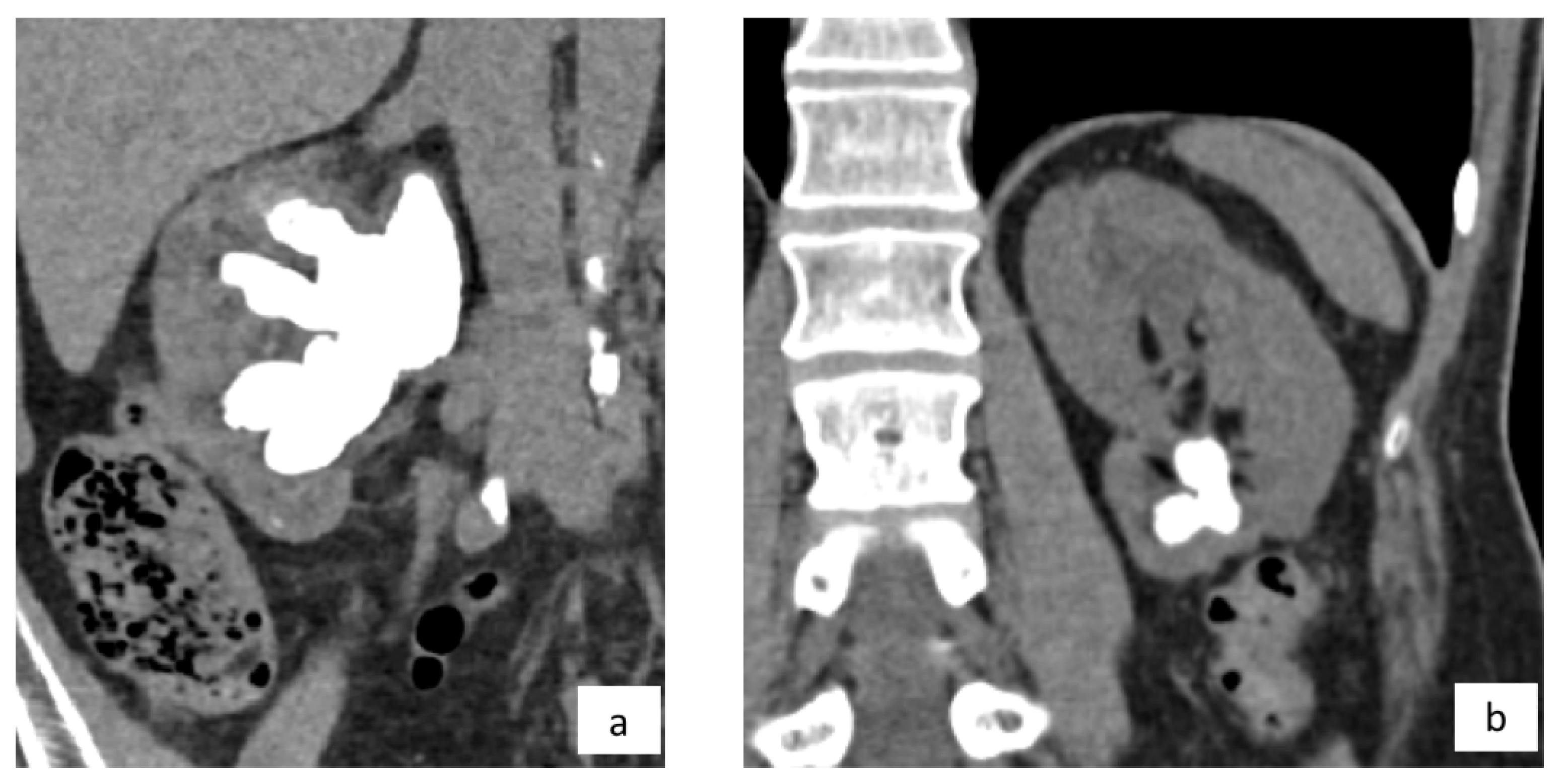 Supine PCNL In Patient With Staghorn Renal Stone And Severe supine-pcnl-in-patient-with-staghorn-renal-stone-and-severe