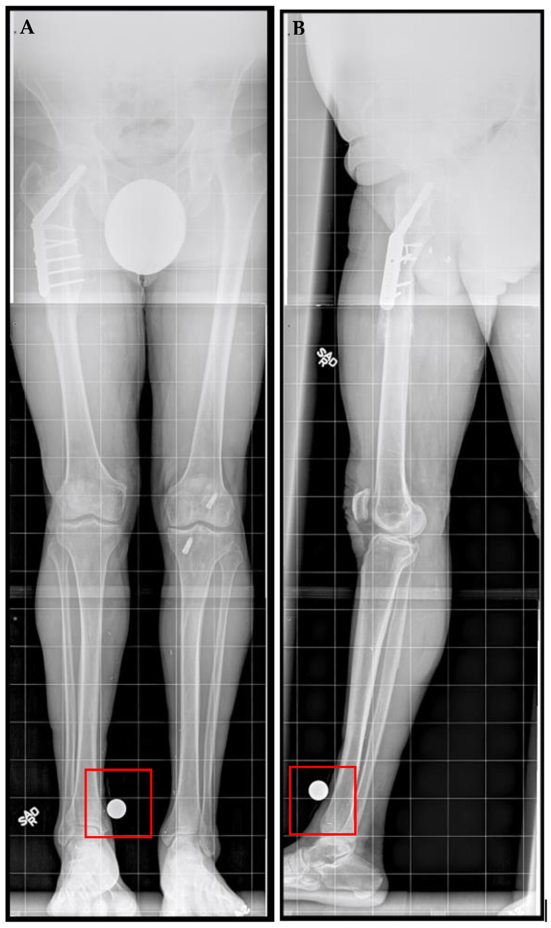Motorized Intramedullary Nail Lengthening in the Older
