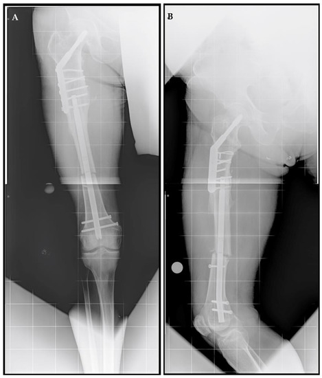 Motorized Intramedullary Nail Lengthening in the Older