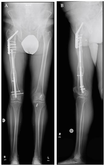 Motorized Intramedullary Nail Lengthening in the Older