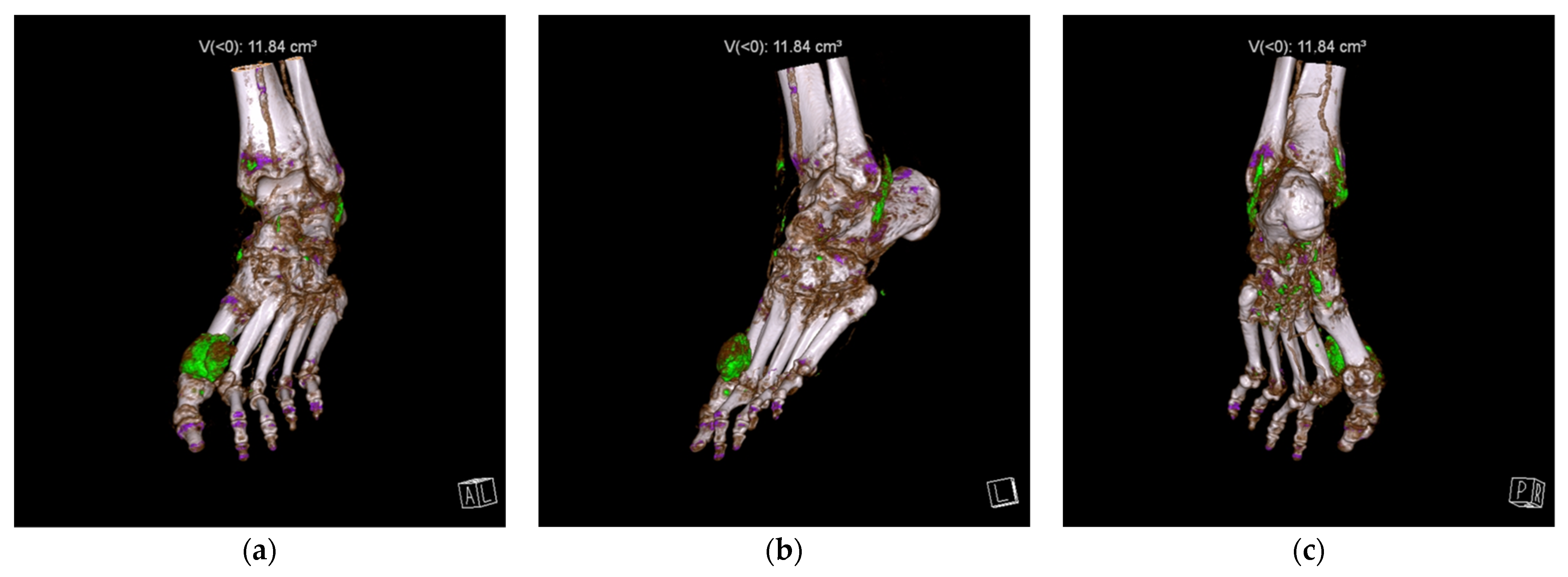 Dual Energy CT Scanning Variable Sensitivity For Gout In 42 OFF dual-energy-ct-scanning-variable-sensitivity-for-gout-in-42-off