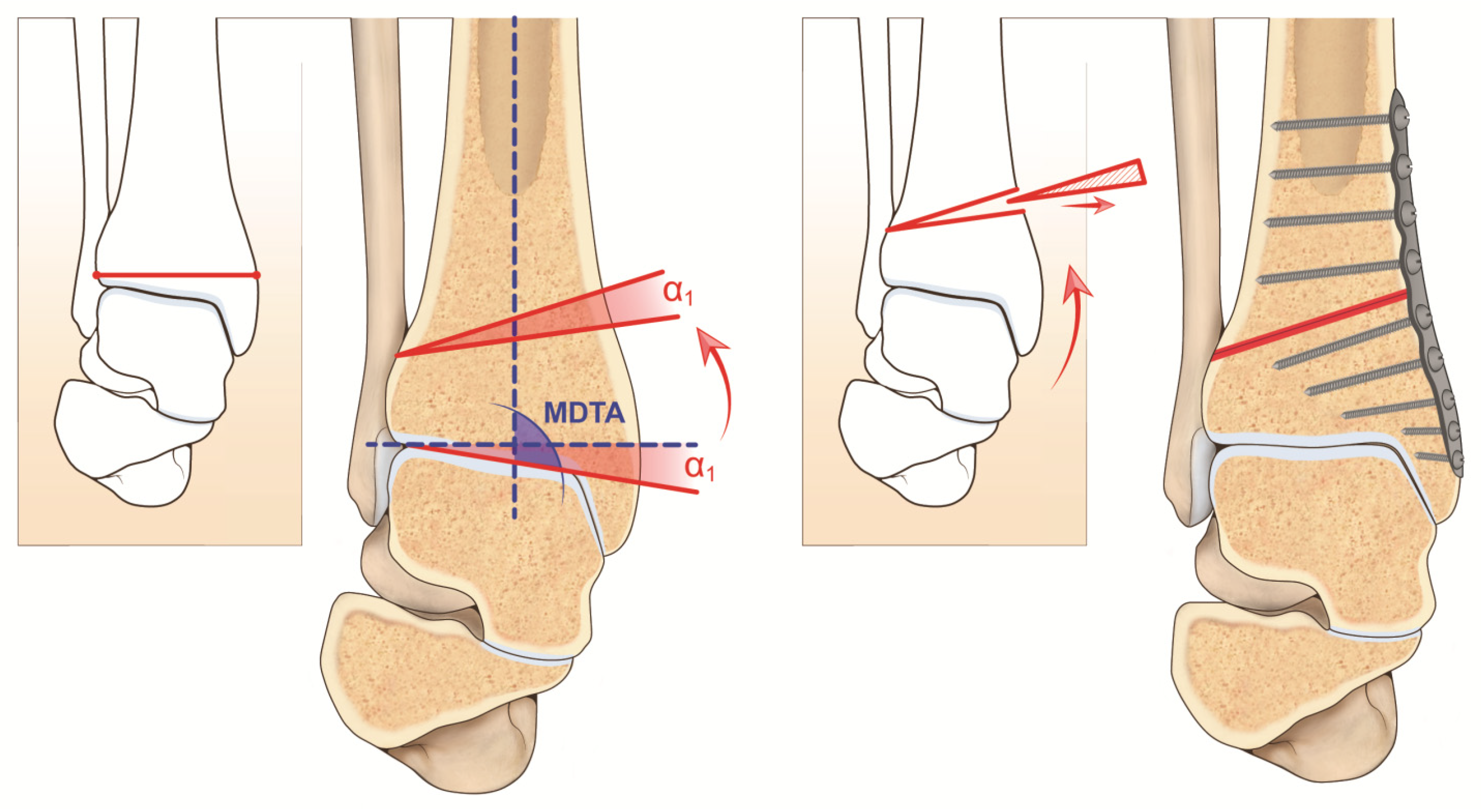 Varus Vs Valgus Fracture varus-vs-valgus-fracture