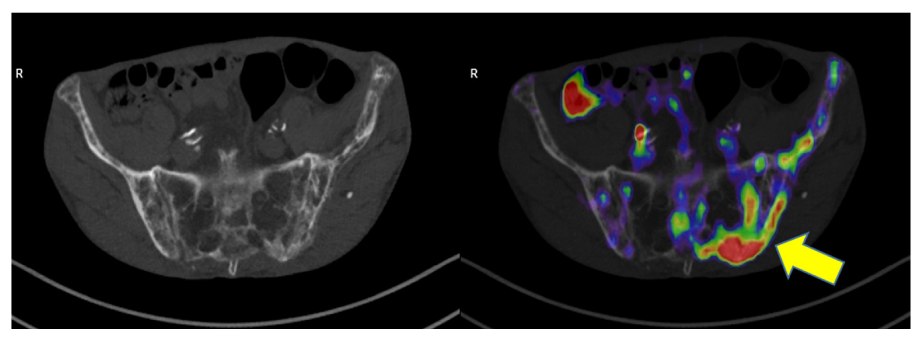 Pagets Disease Skull