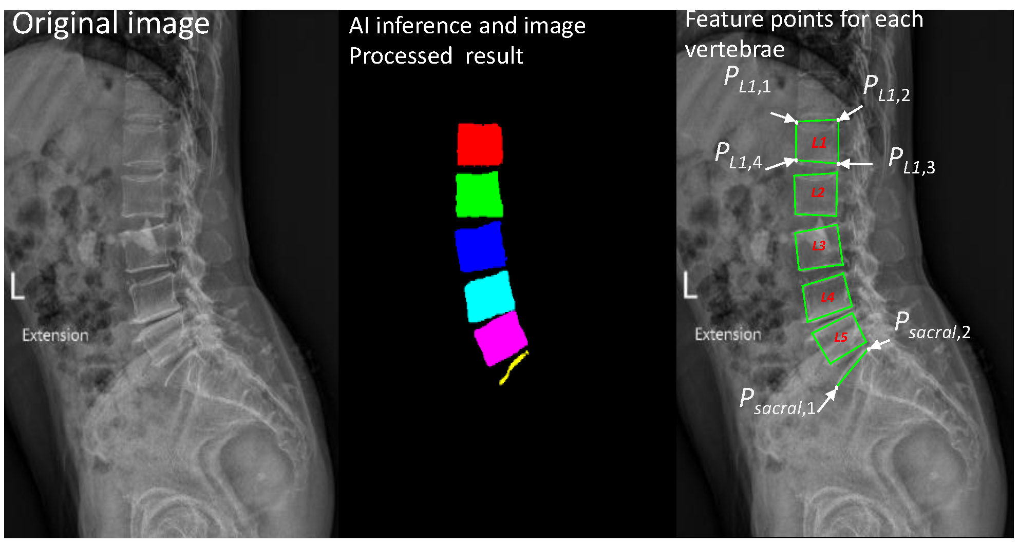JCM | Free Full-Text | Detection of Lumbar Spondylolisthesis from X-ray ...