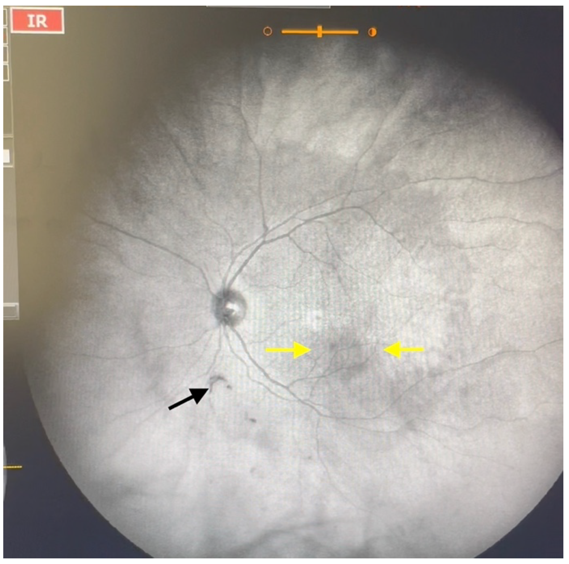 Visualization and Grading of Vitreous Floaters Using Dynamic Ultra ...