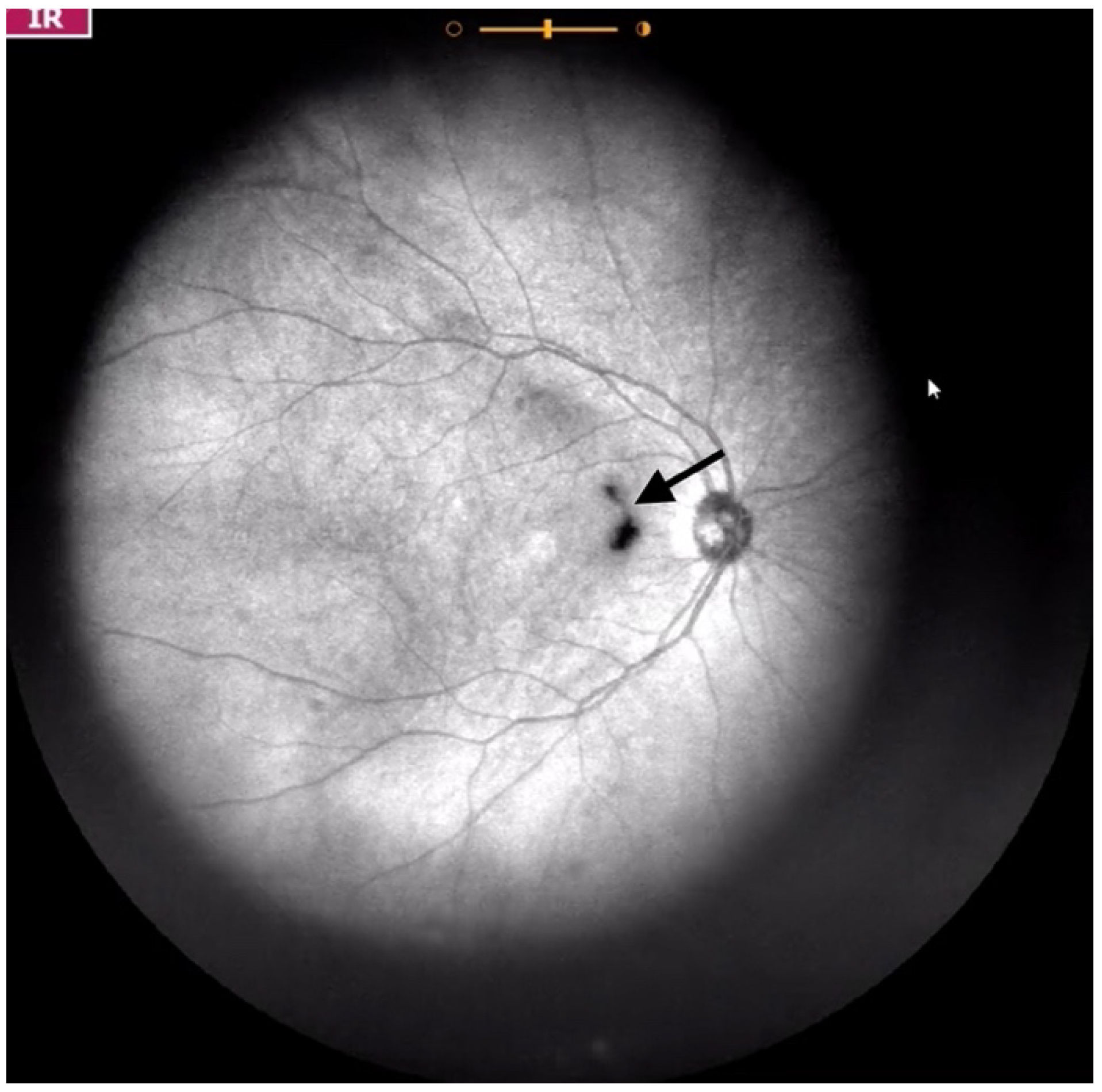 floaters-after-cataract-surgery-treatment-and-causes